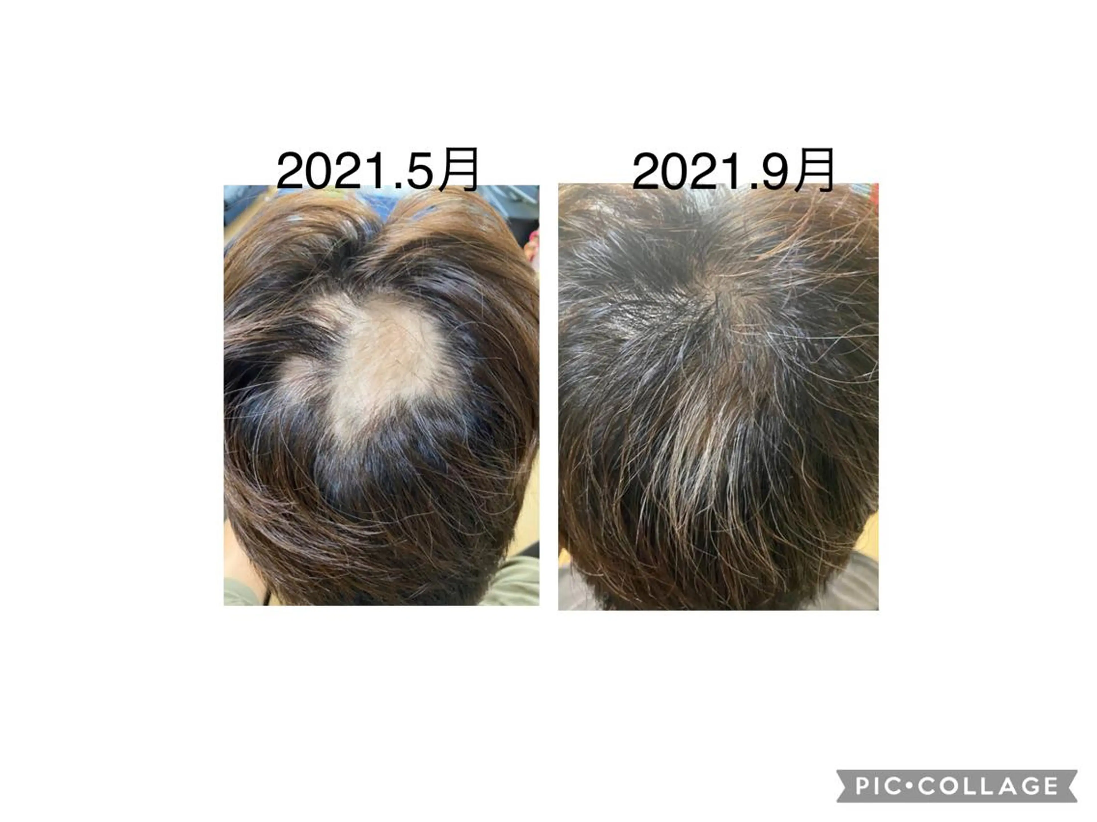 初回限定✨強髪プログラム（ヒト肝細胞培養液）を使用した頭皮ケアの写真