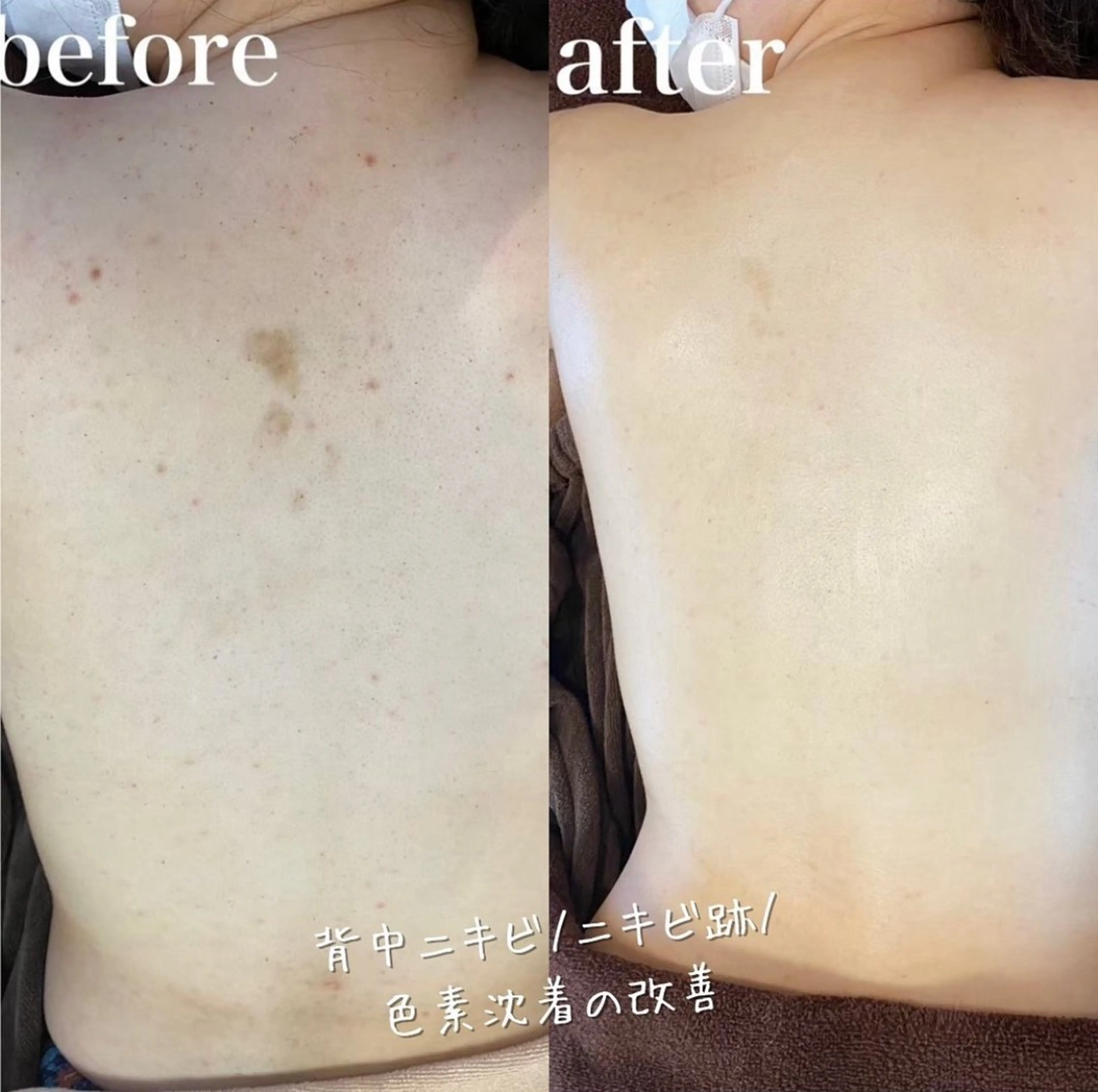 【ツルスベ美背中に♪】お背中ハーブピーリング 🌿（上部or下部）ニキビケア、シミ改善のビタミンC美容液リキッド付きの写真