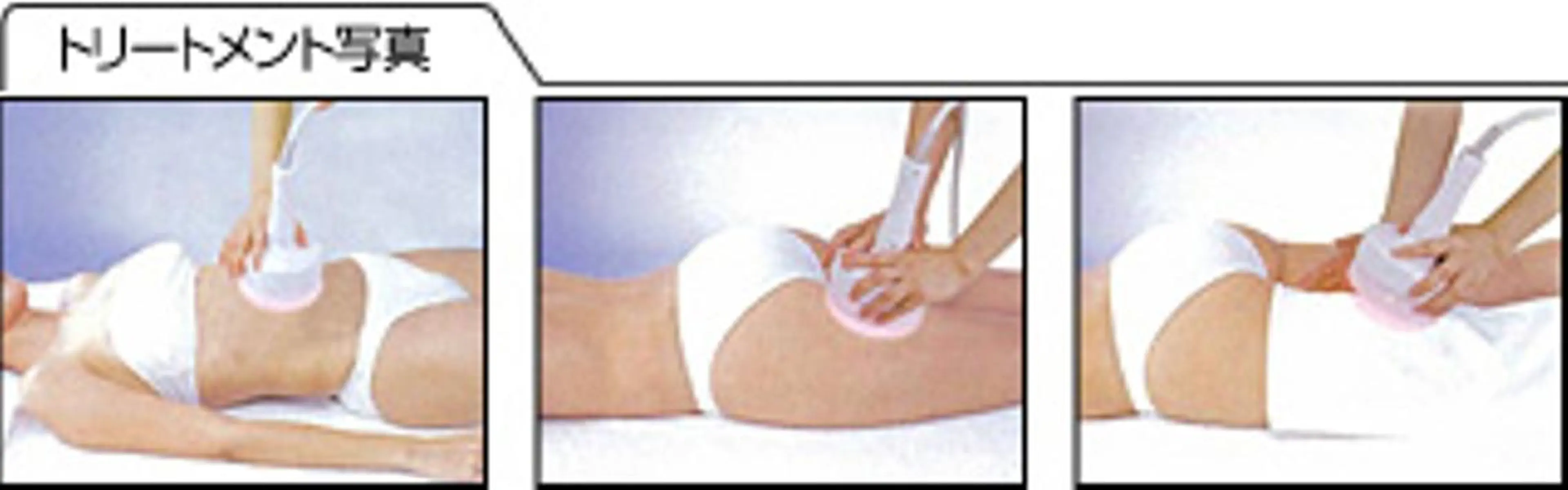 【年末キャンペーン11/15-12/30】セルライト除去痩身コース　60分　5980円の写真