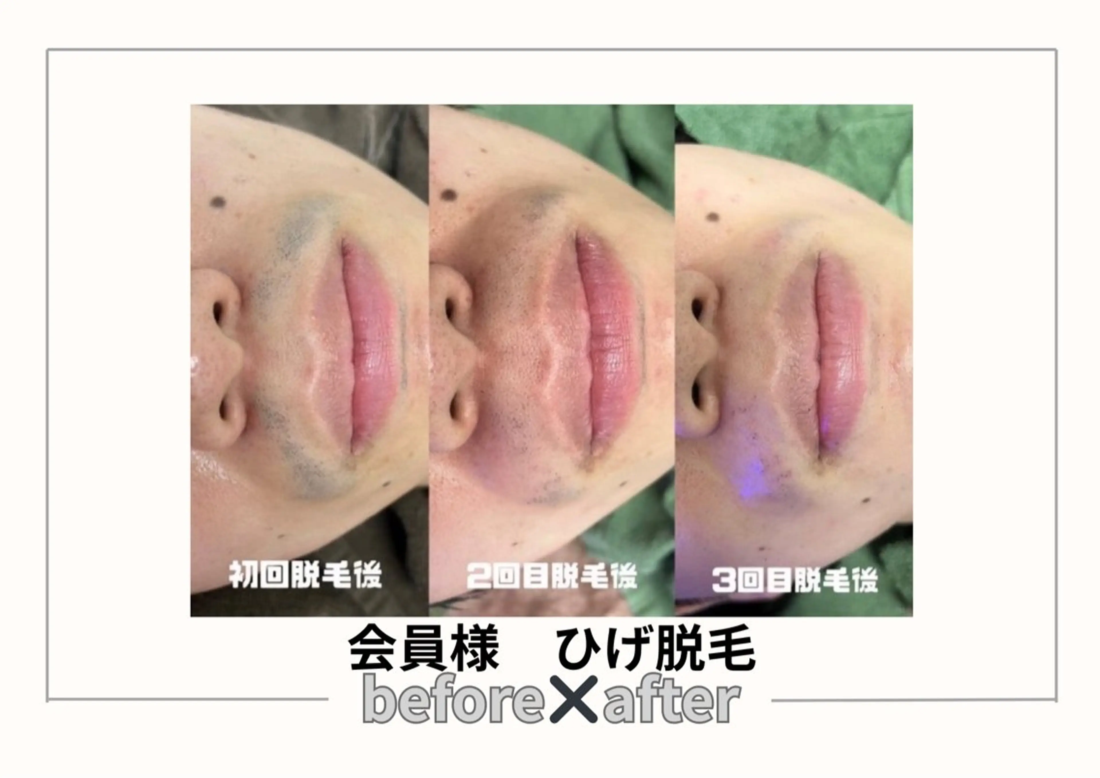 脱毛 みんなの脱毛ツルリン ☀️船橋店☀️のエステ・リラクイメージ