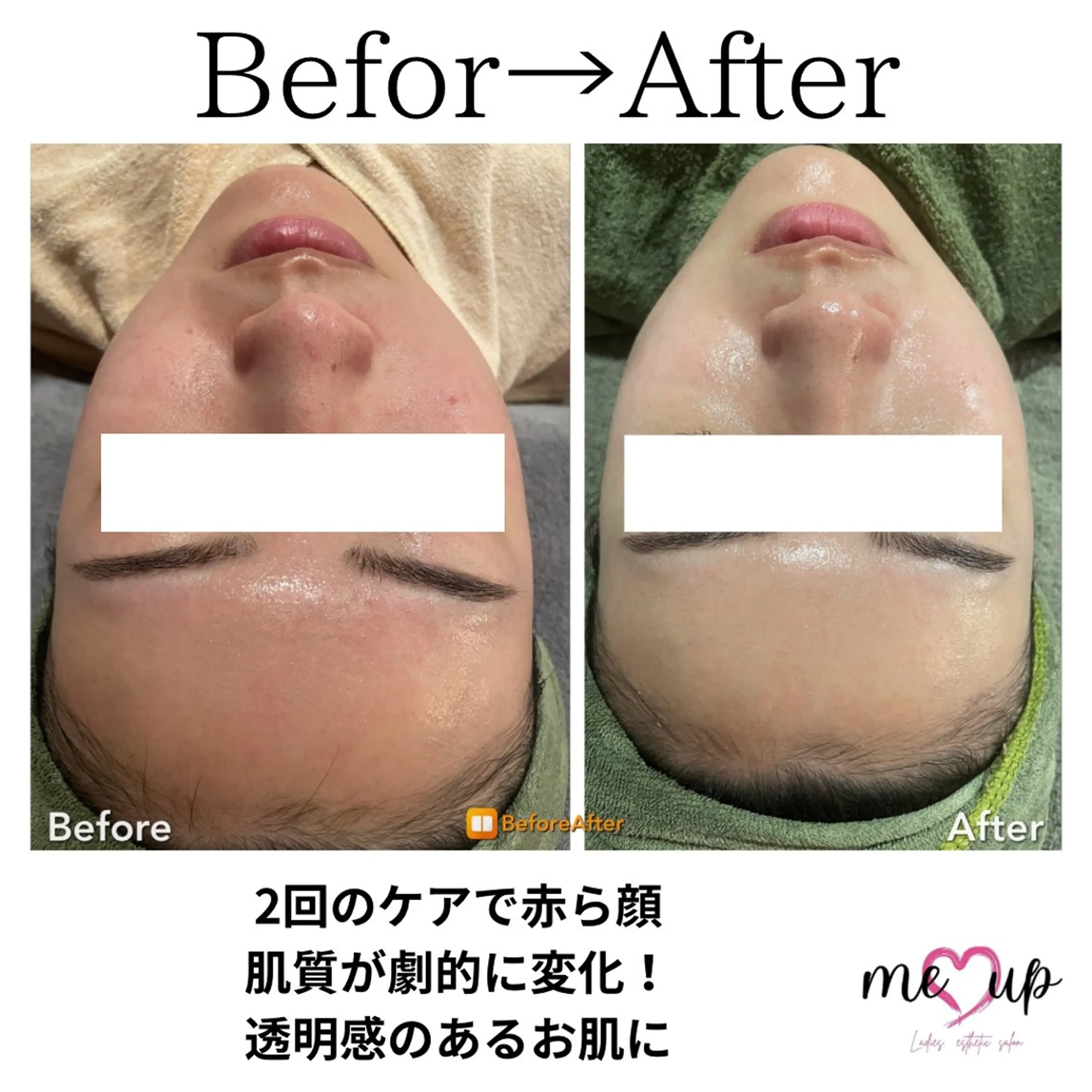 エステ Meupニキビ専門店 背中/ハーブ/肌管理のその他イメージ