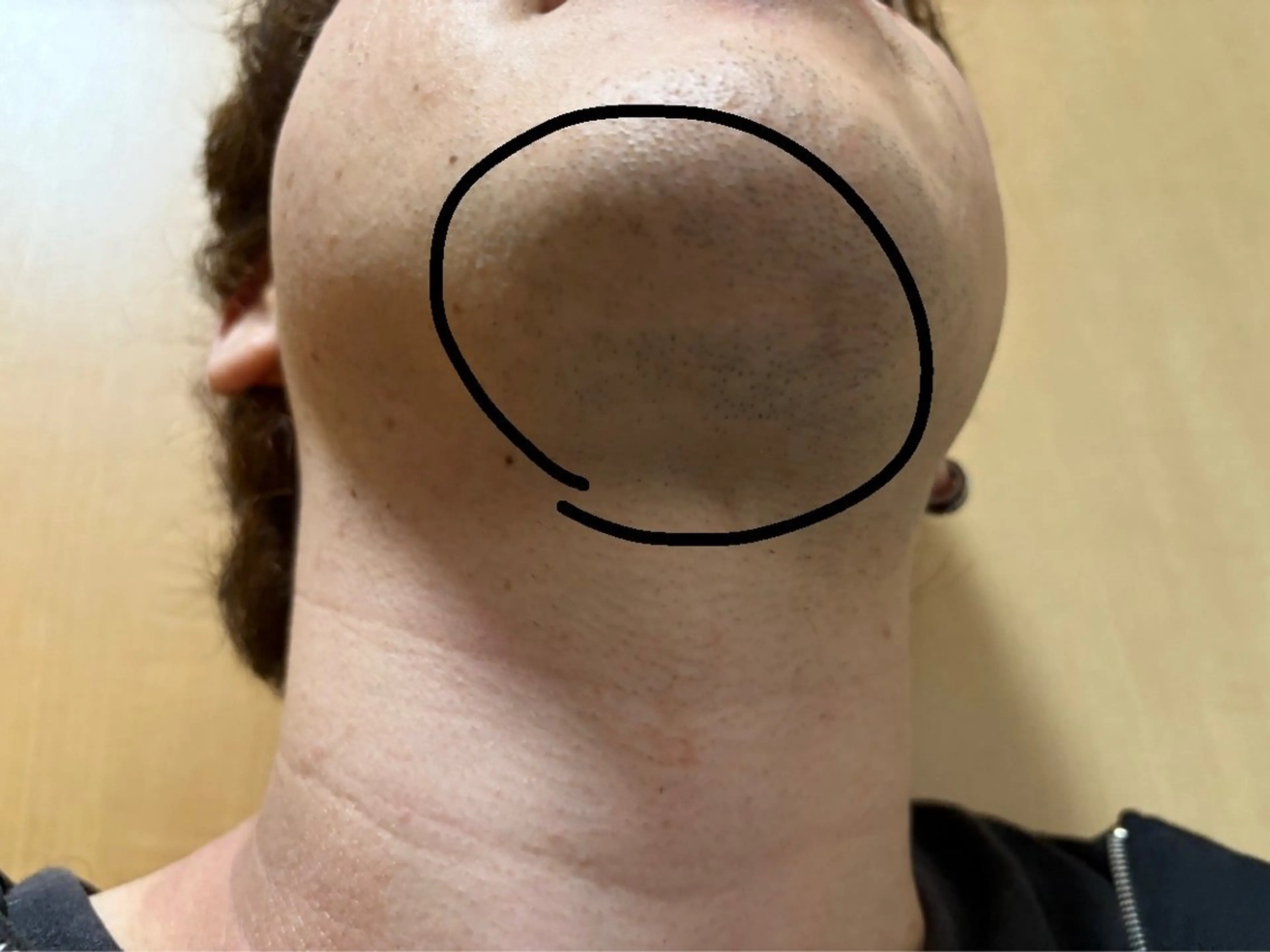 【メン人気No.1】メンズ顔脱毛(顔、首)🎱¥3300🎱の写真