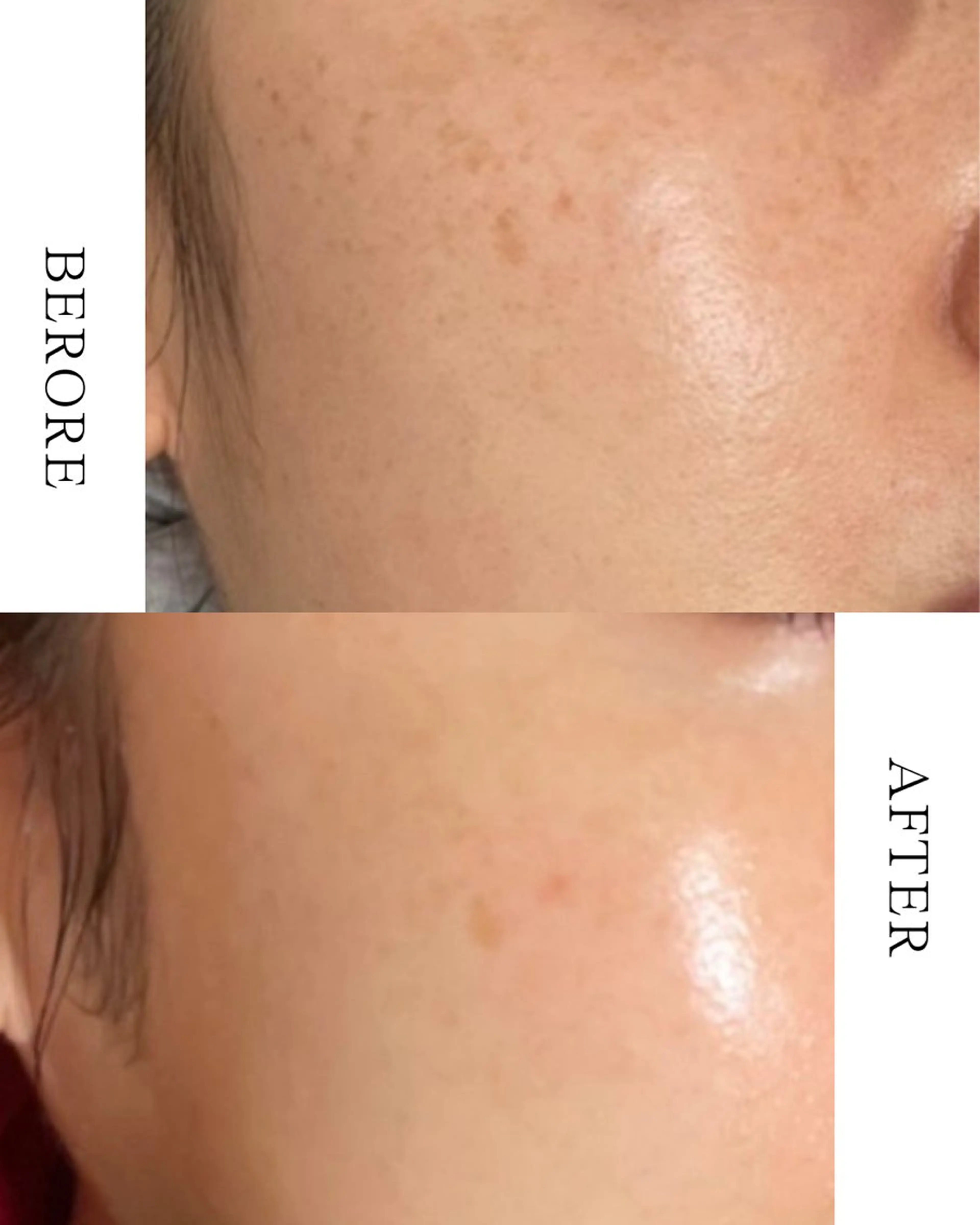 ✨韓国クリニック発🇰🇷話題のララピール✨の写真