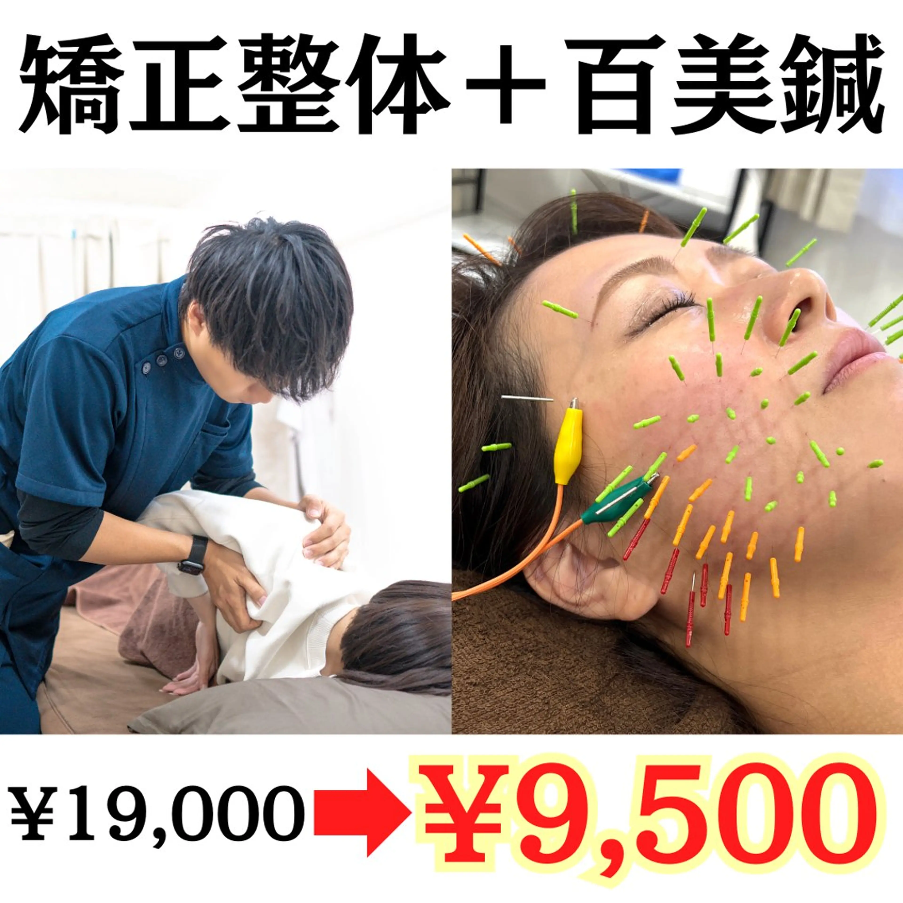 【✨ミニモSALE✨】矯正整体＋百美鍼（90分）(猫背/肩こり/腰痛/小顔/リフトアップ/シワ/たるみ)の写真