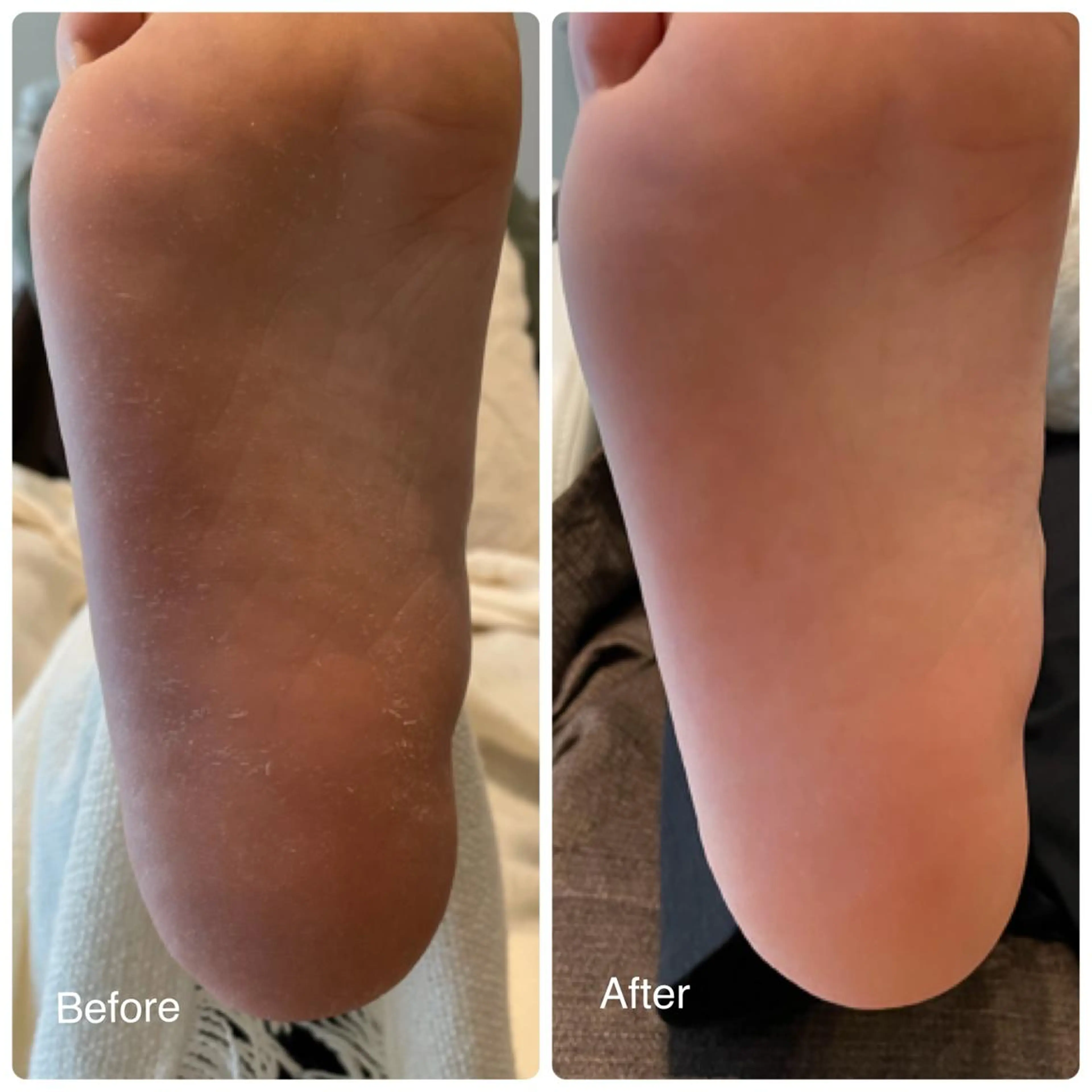 秋冬でかさついたかかとをツルツルに🦶マシーンでしっかり角質除去で赤ちゃんかかと✨の写真