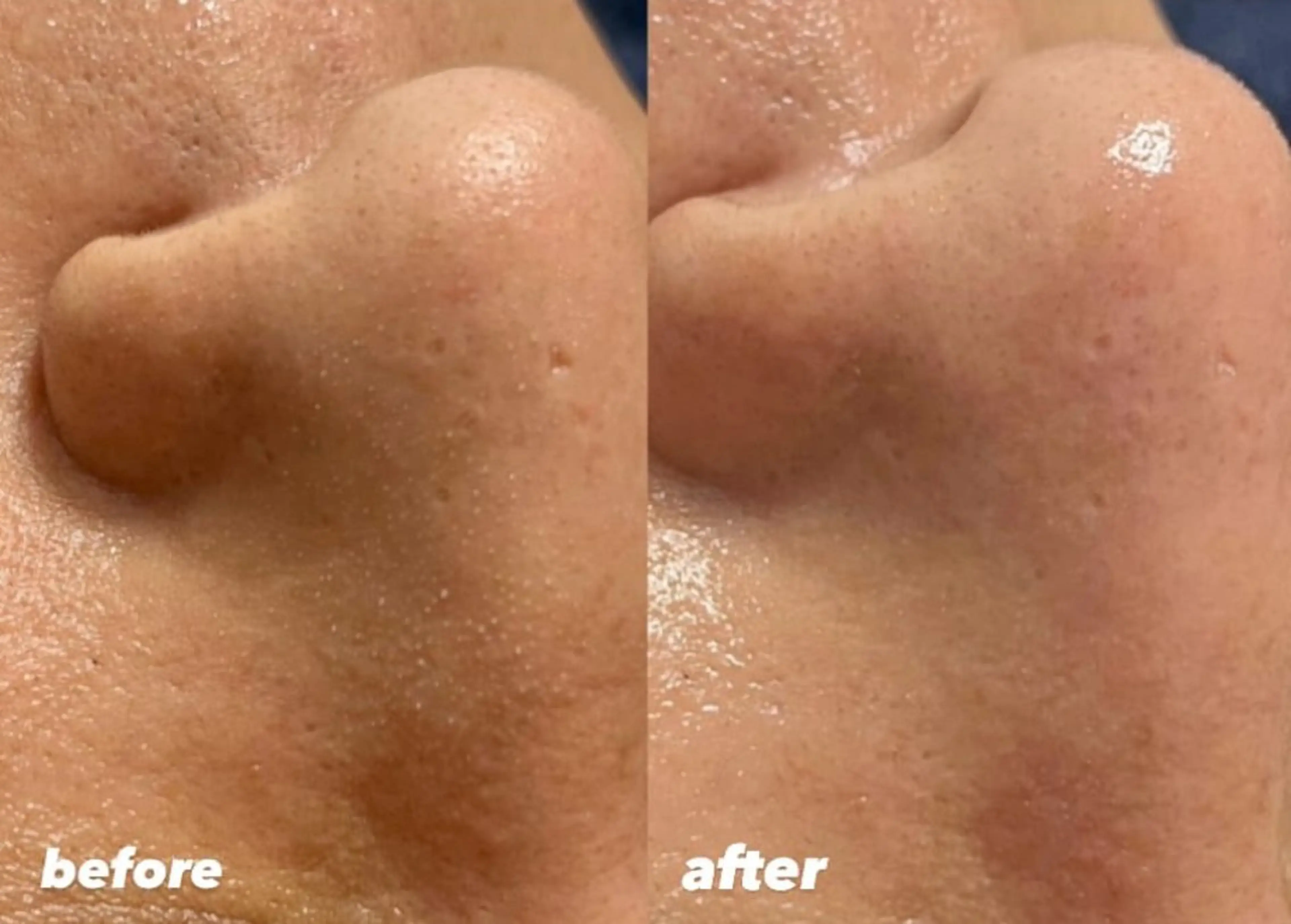 1✨大バズり中毛穴洗浄 ✨【最先端毛穴サヨナラ】ハイドロフェイシャル毛穴洗浄14,000→6,600の写真