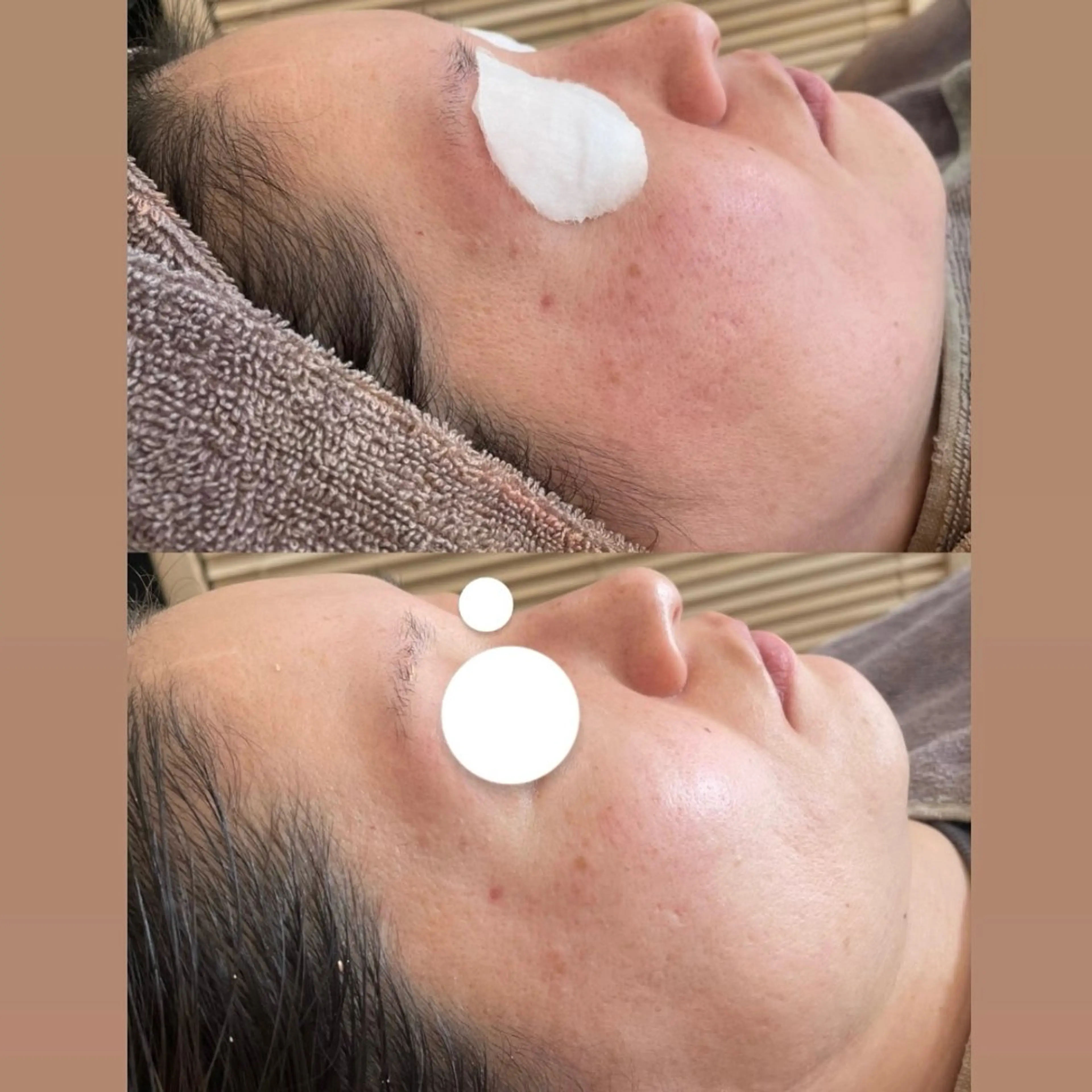 【角質除去】古い角質を取り除き、ターンオーバーを促します💫くすみのない、肌本来の透明感への写真