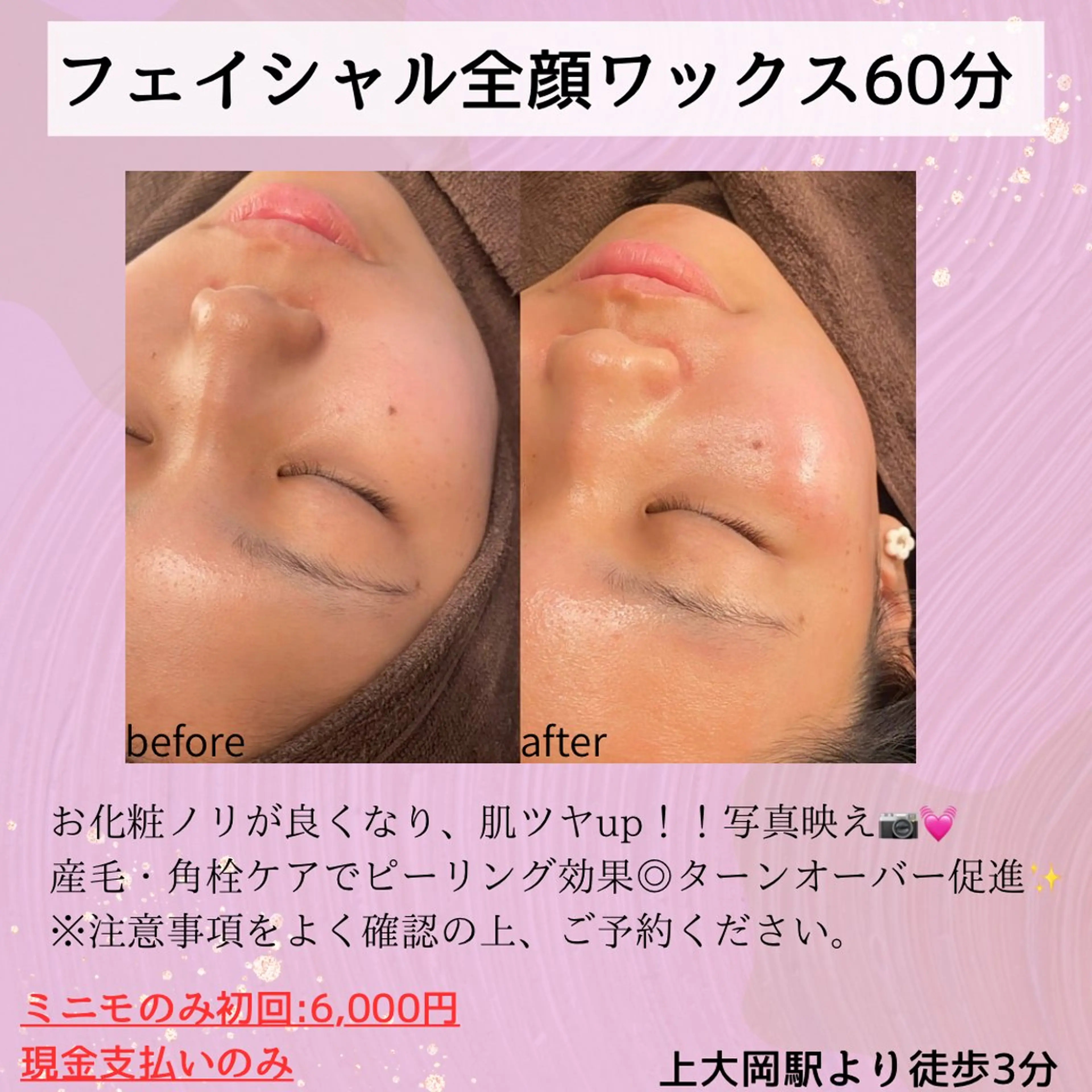 フェイシャル全顔ワックス✨産毛や角質ケアができピーリング効果◎お化粧ノリ・ツヤupで写真映え💖の写真