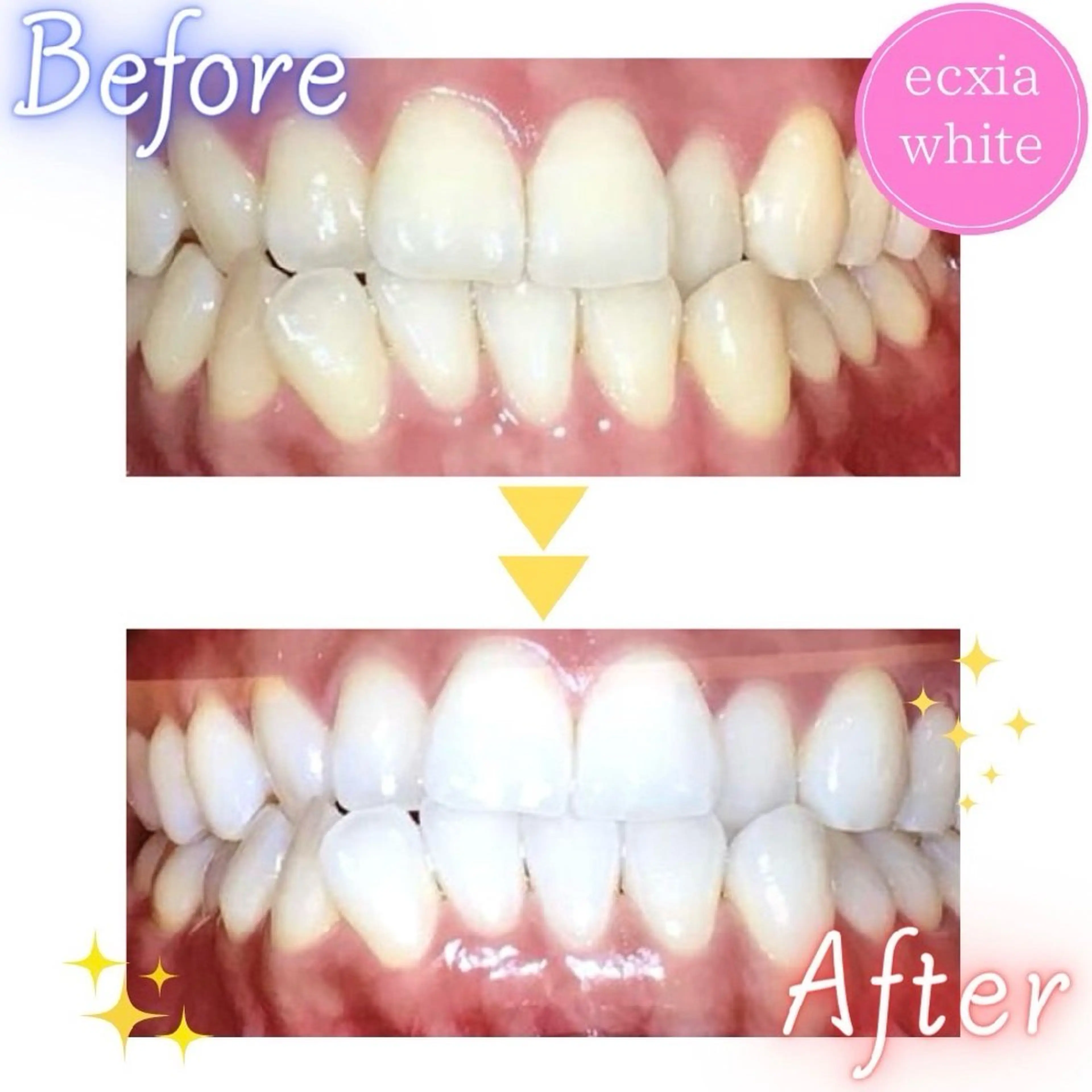 【人気NO.1】強力 セルフホワイトニング(9分2セット)1回 ¥3980 別途料金なしの写真