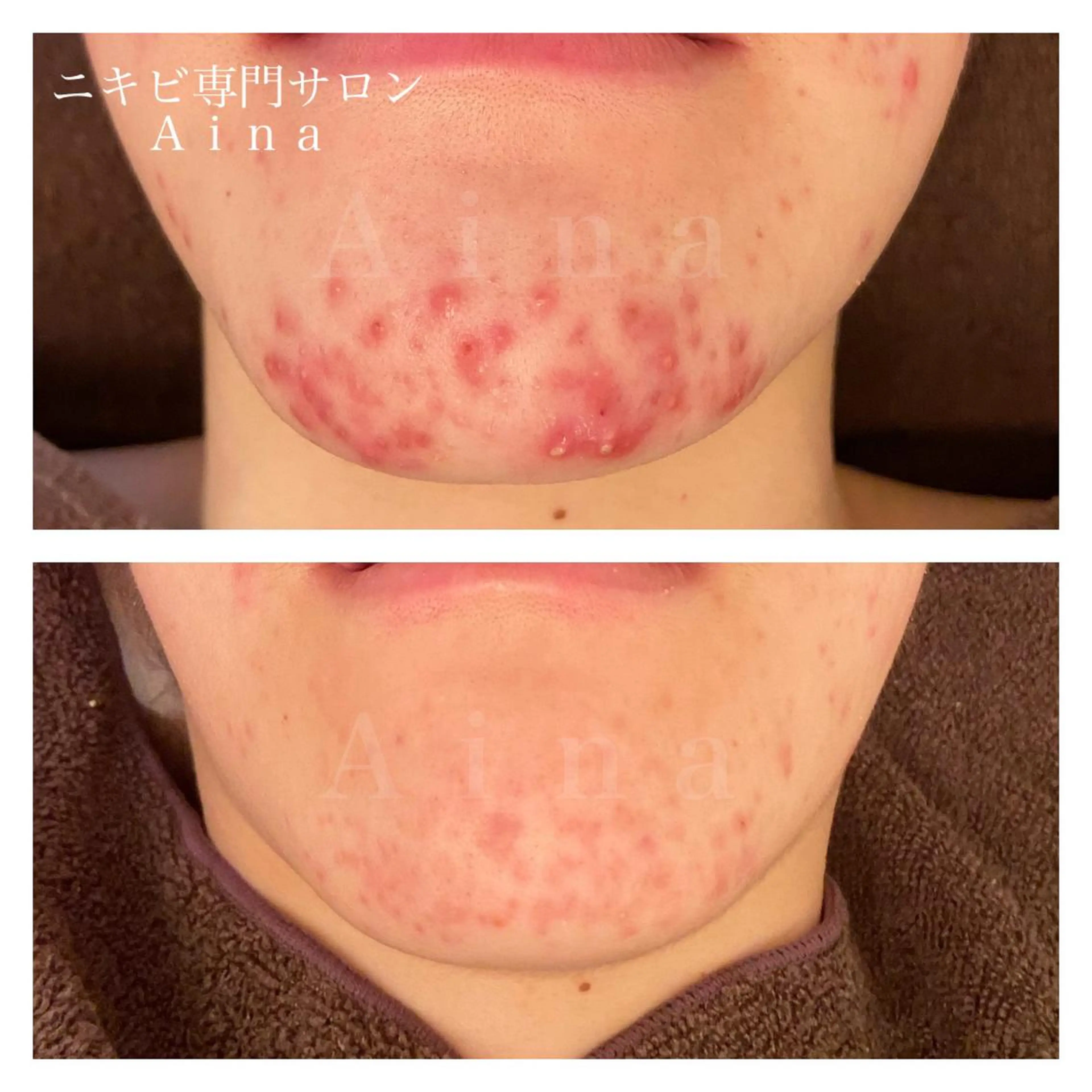 ミディアム ヘアアレンジ メンズ キッズ ネイル マツエク・マツパ アイブロウ 赤色 エステ リラク ニキビ跡専門サロン Ａｉｎａのエステ・リラクイメージ