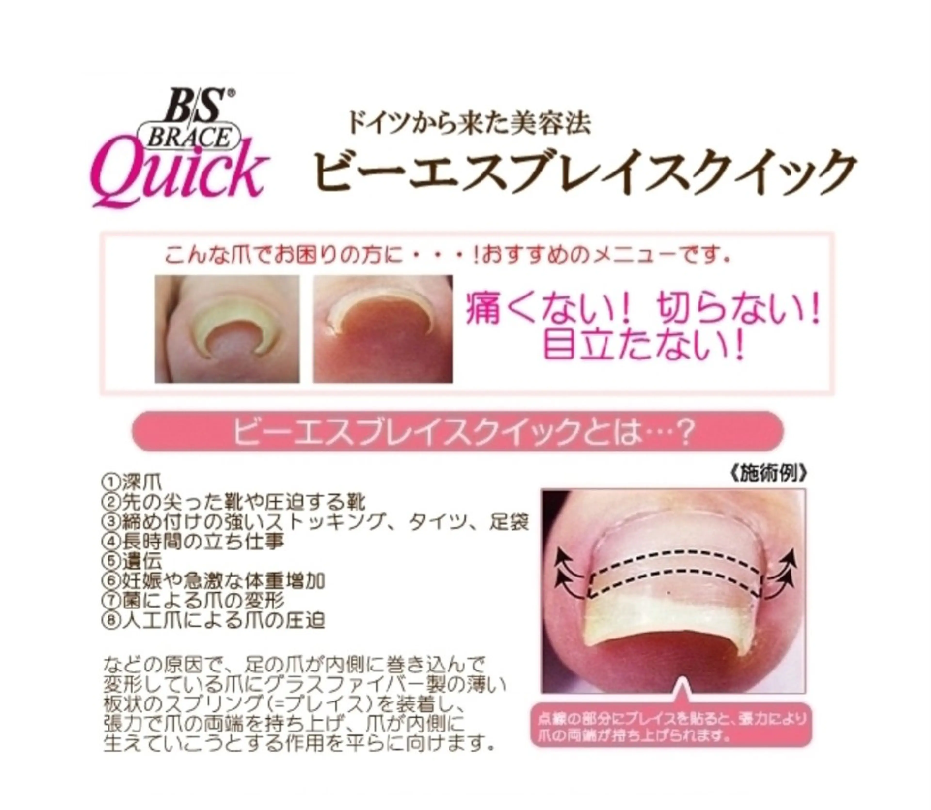 足の親指巻き爪矯正1本の写真