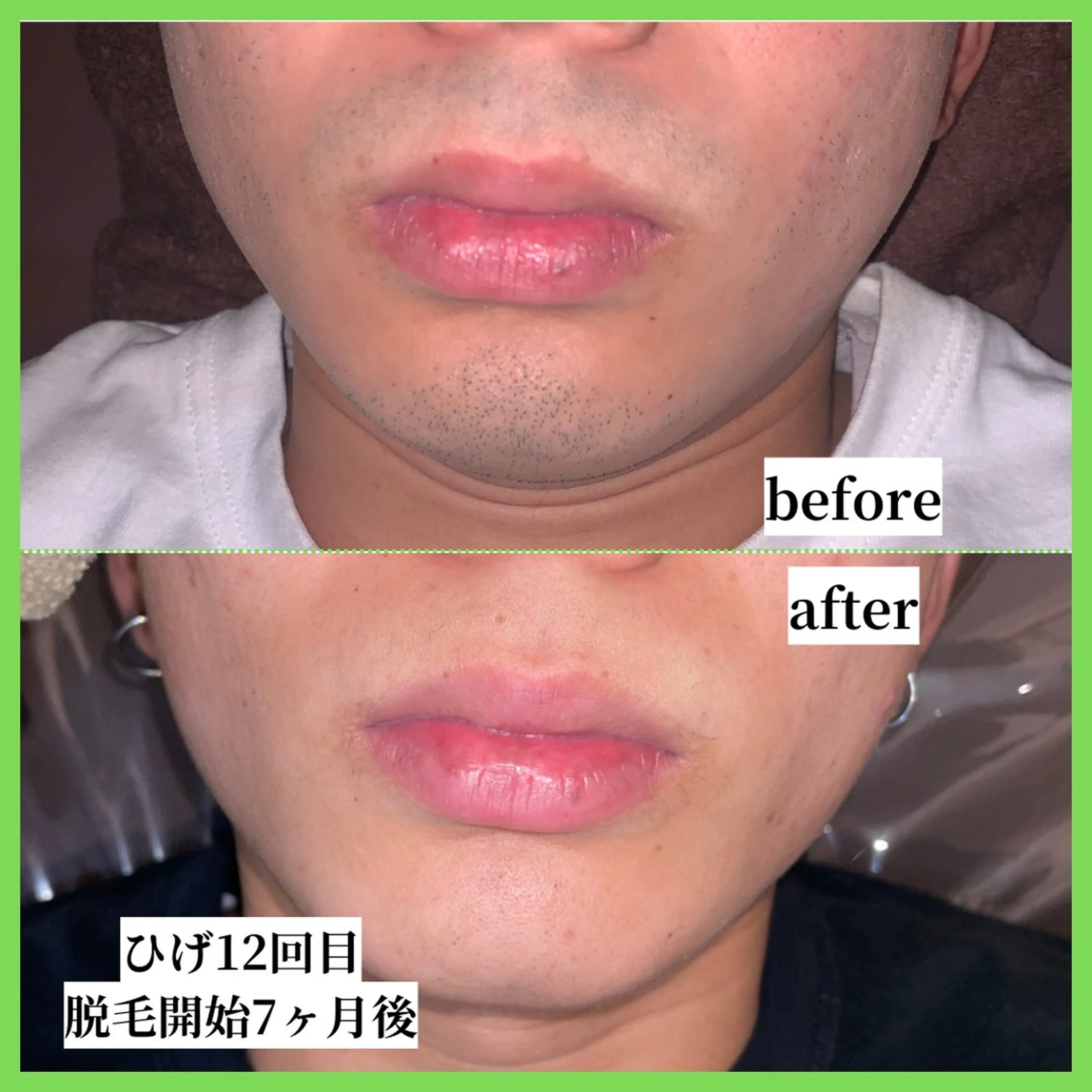 メンズ 脱毛 天神【効果重視脱毛】 YouMakeのエステ・リラクイメージ