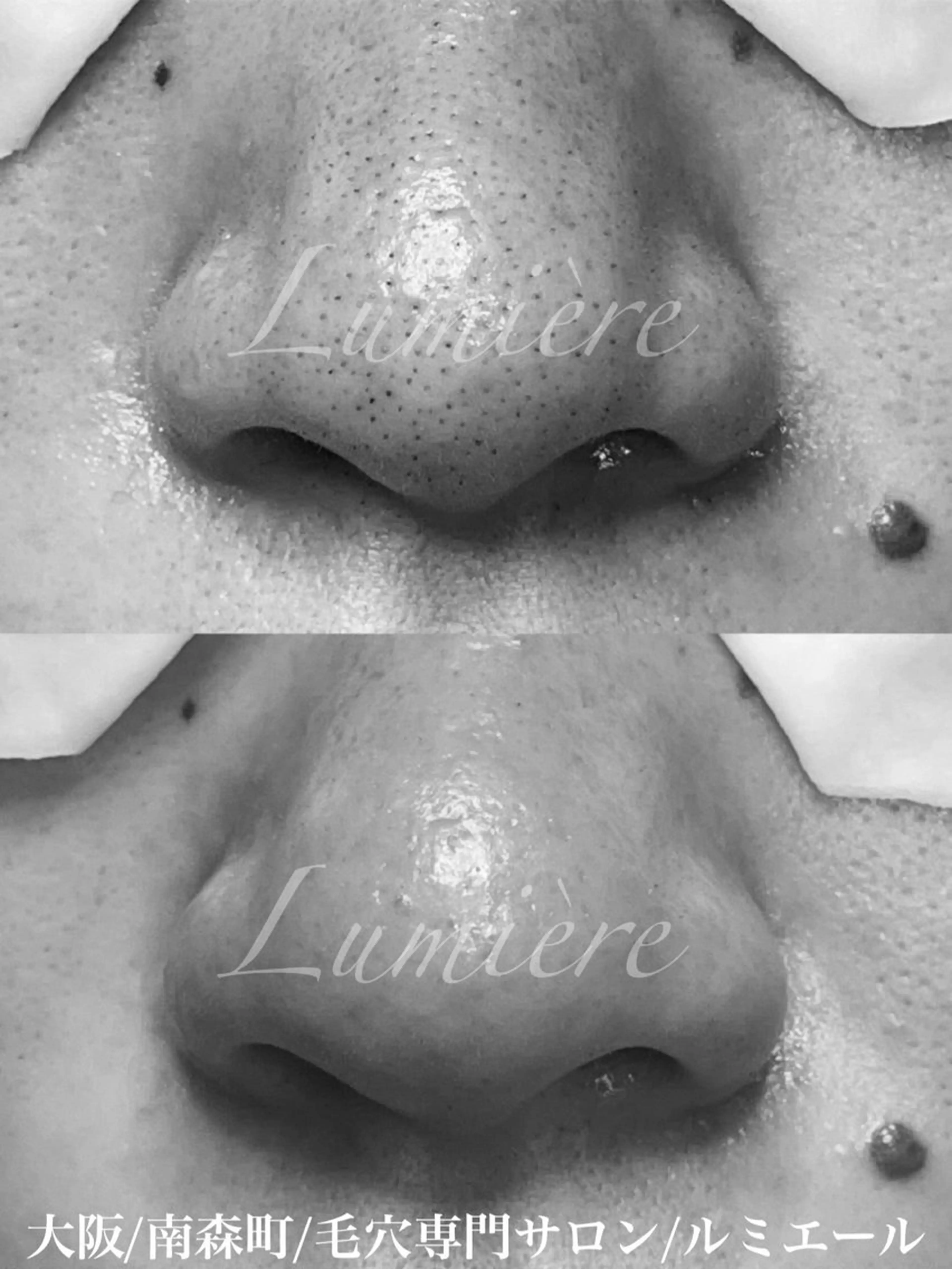 【🍓いちご鼻撃退🍓】毛穴エクストラクションで黒ずみ・ざらつき改善✨感動の手触り🥹初めての方限定プランの写真