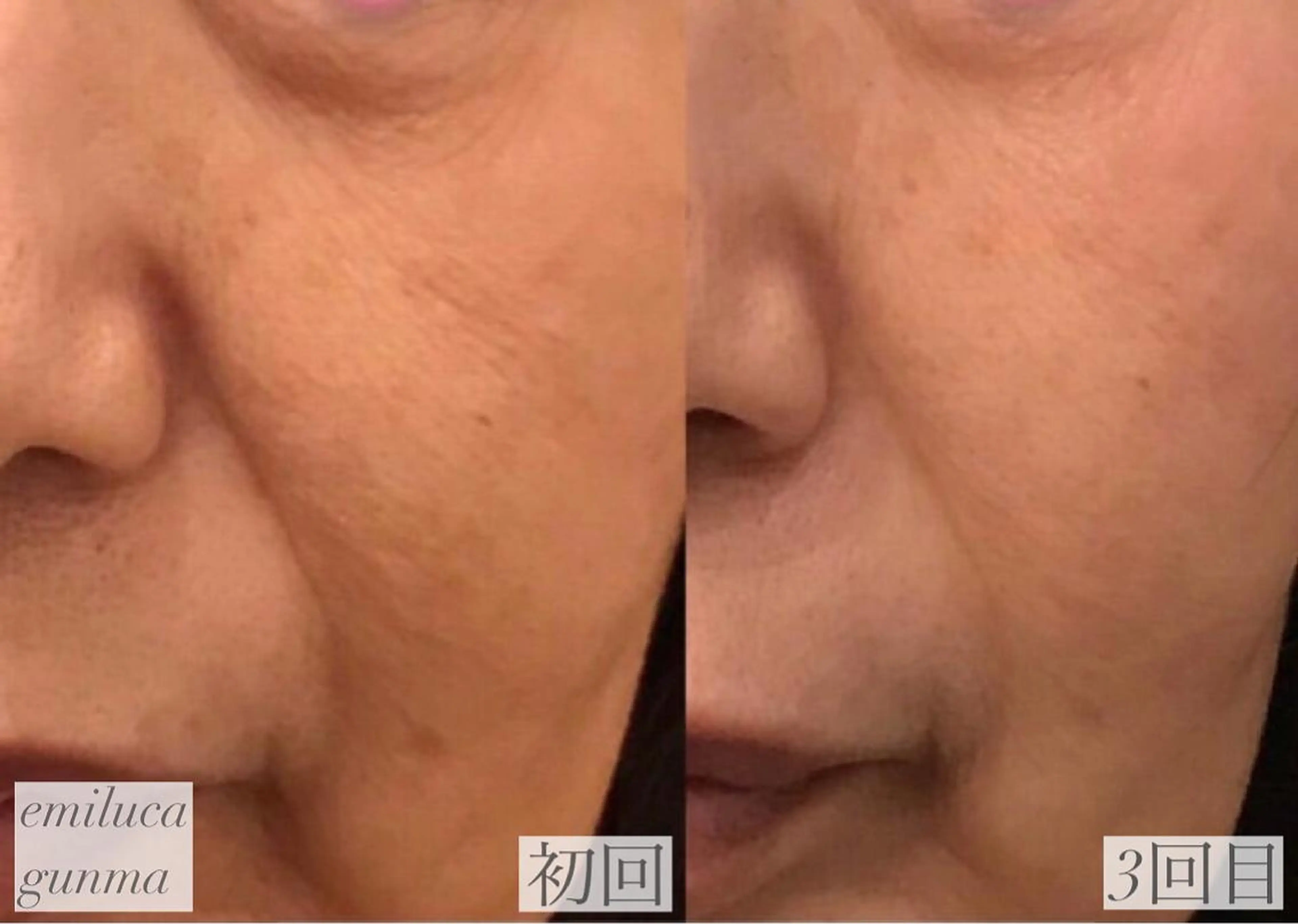 emiluca西目/ 毛穴洗浄/細胞美容のエステ・リラクイメージ