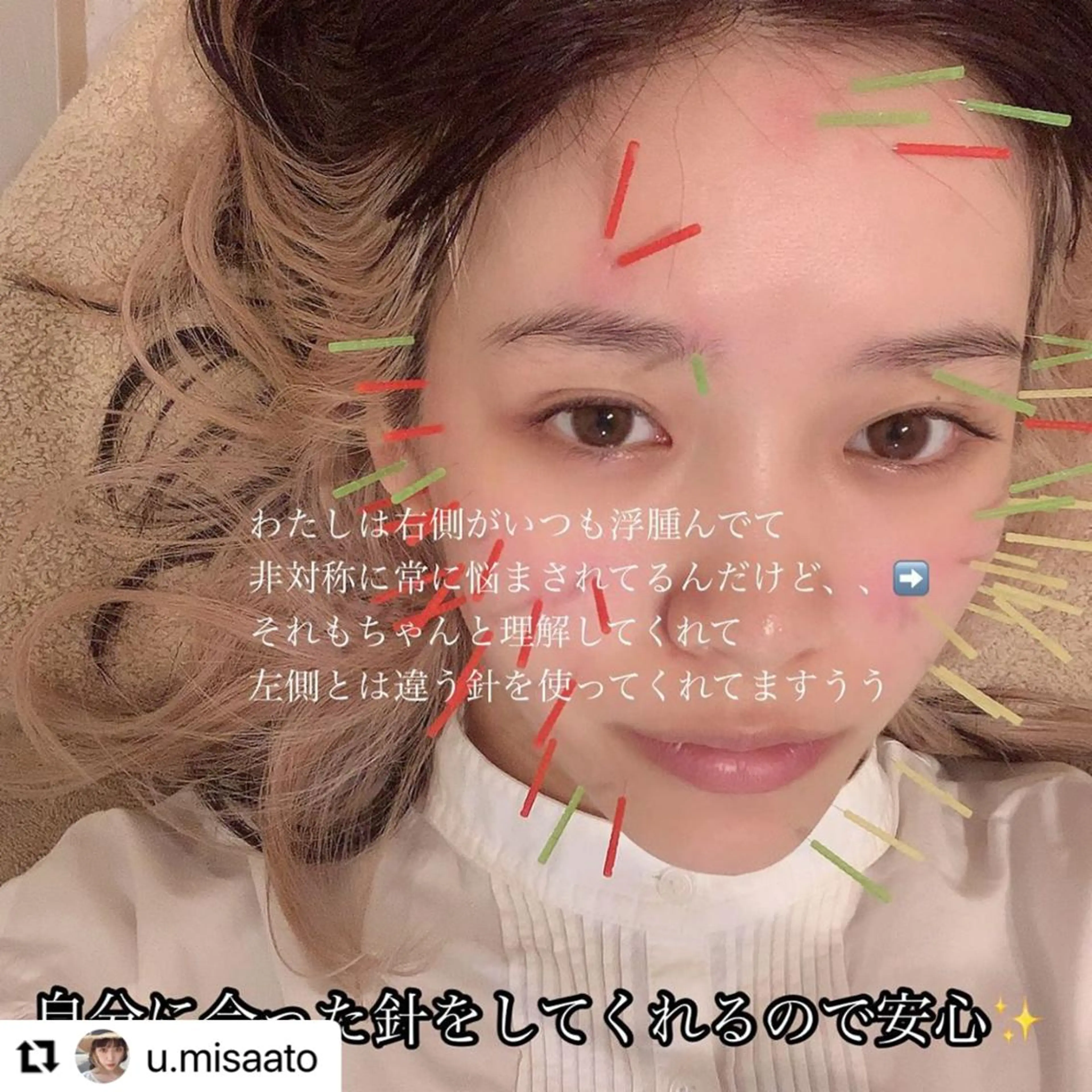 鍼灸整骨院Refine所属・鍼灸 Refineのその他イメージ