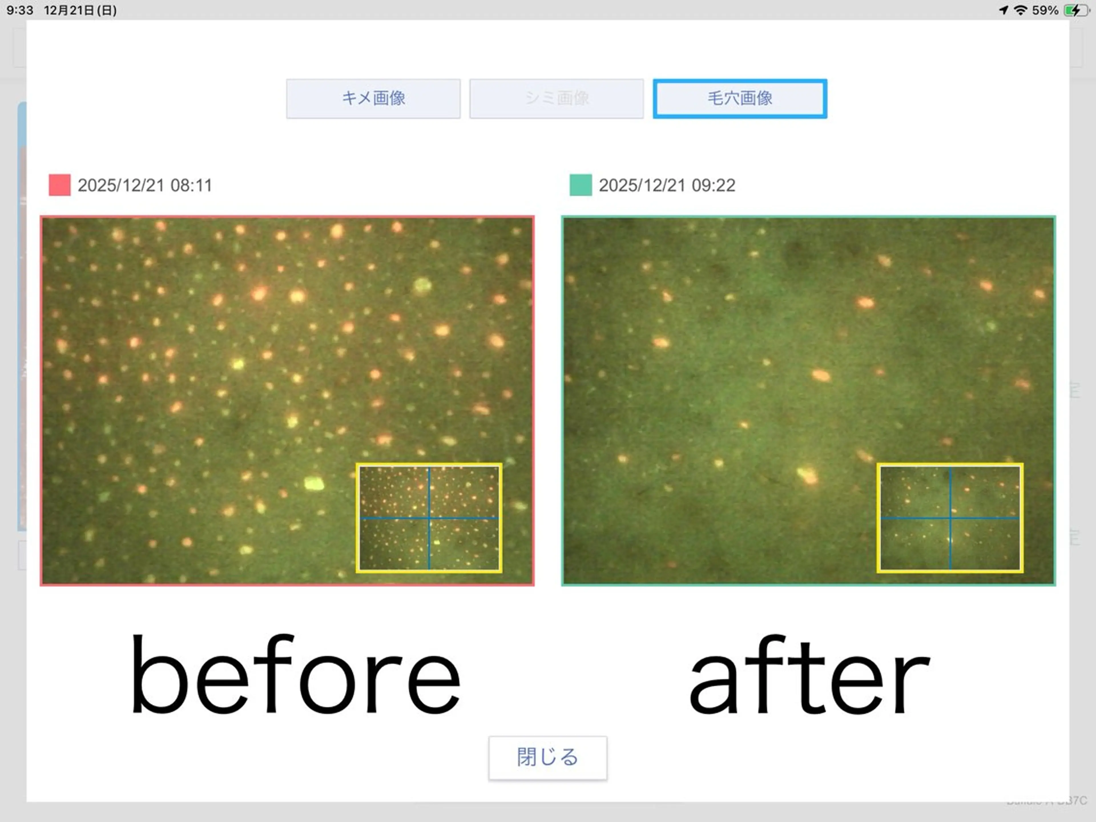 【迷う人はこれ】オーヴル毛穴リポア(汚れ1回で綺麗に取りたい人◎)スチーマー・毛穴カメラ診断付きの写真