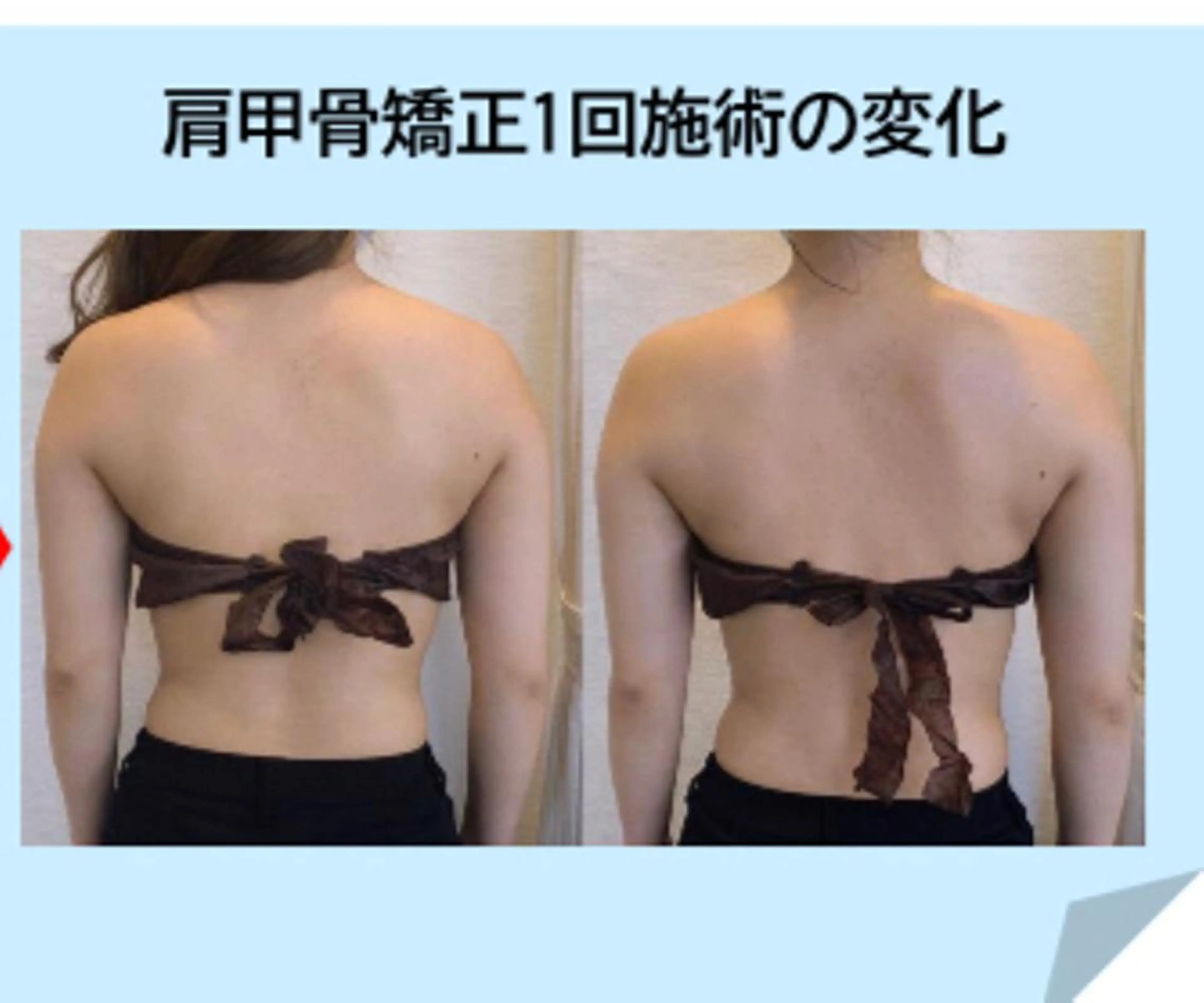 猫背改善メニュー🎶肩甲骨矯正で姿勢美人に❣️5回券の写真