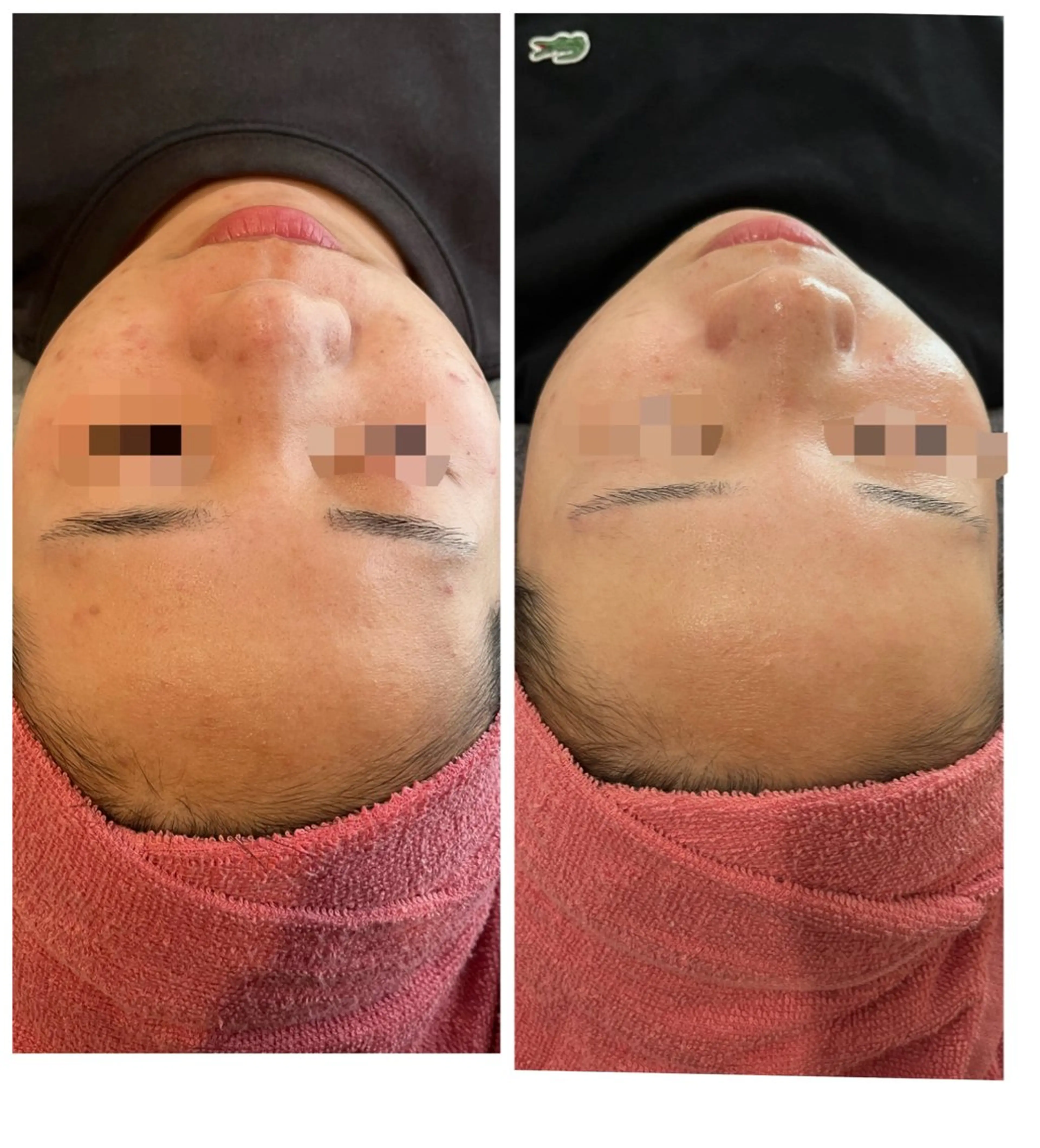 エステ 【リベルハーブピーリング認定店】敏感肌・美白脱毛専門店Dione立川店所属・Dione 立川店のエステ・リラクイメージ