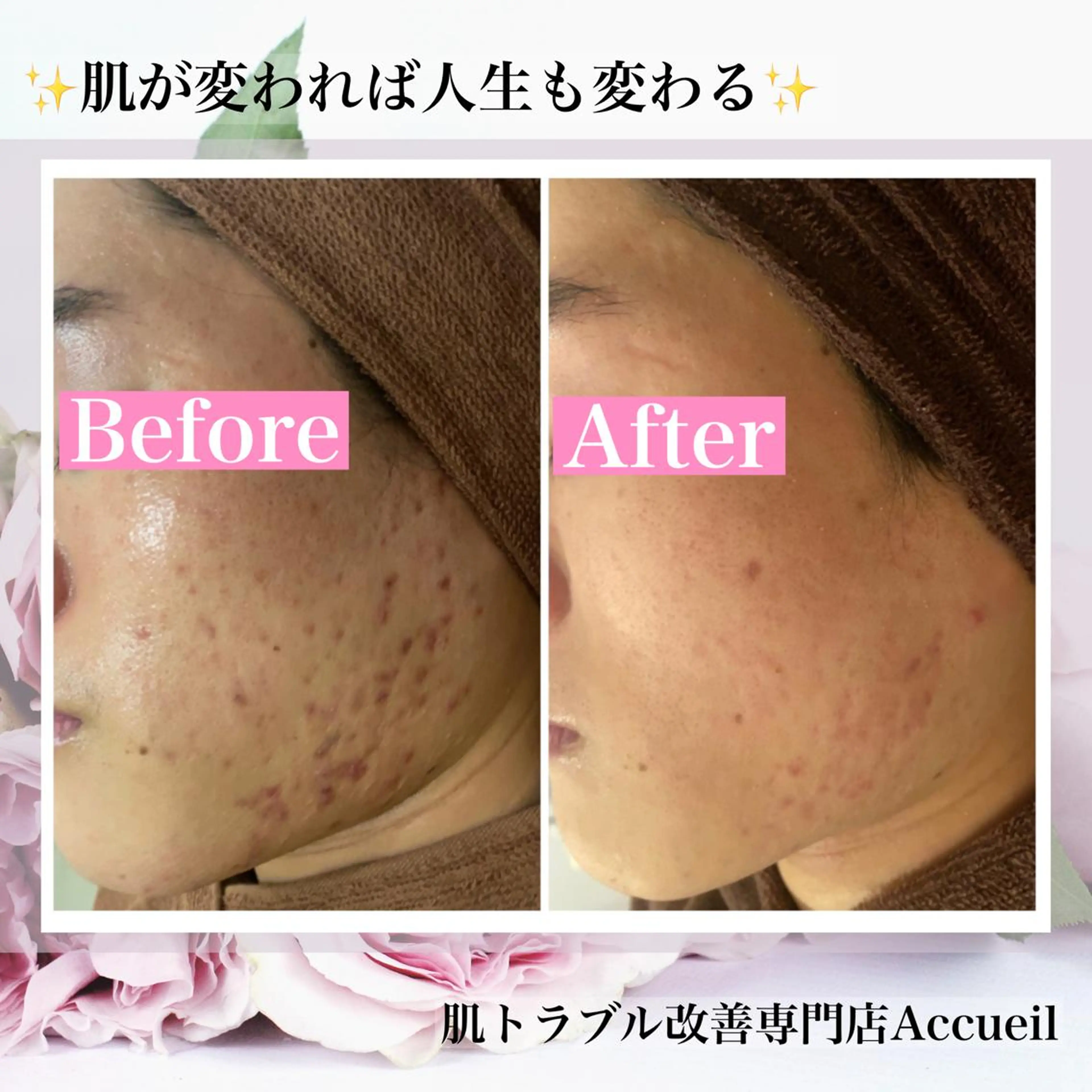 ミディアム カラー パーマ ヘアアレンジ メンズ キッズ ネイル マツエク・マツパ エステ リラク ニキビ・肌質改善専門 ♡人生が変わるサロンのエステ・リラクイメージ