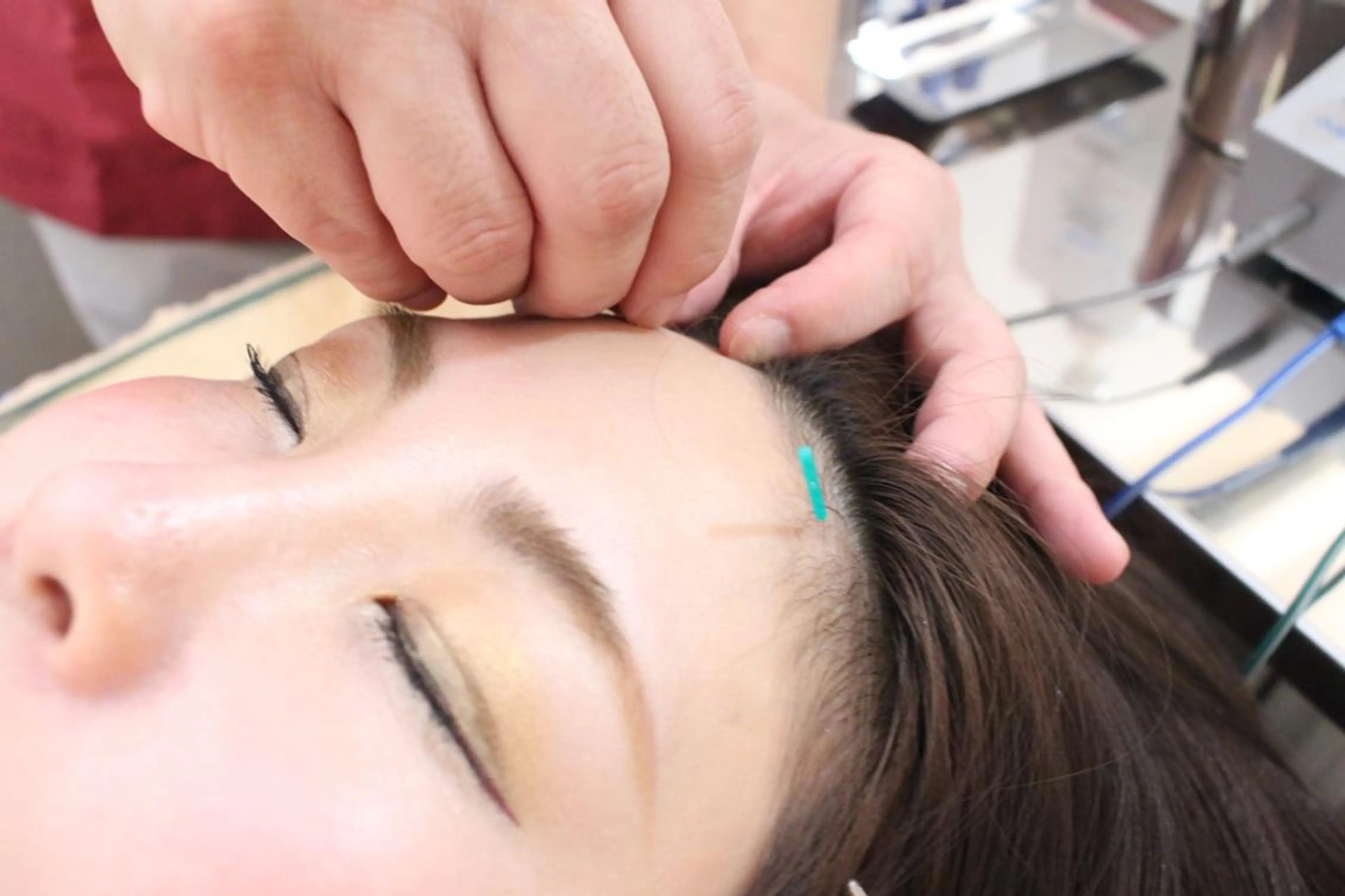 【日曜限定】モニター募集（美容鍼＆光エステ）※毎月先着１名の写真