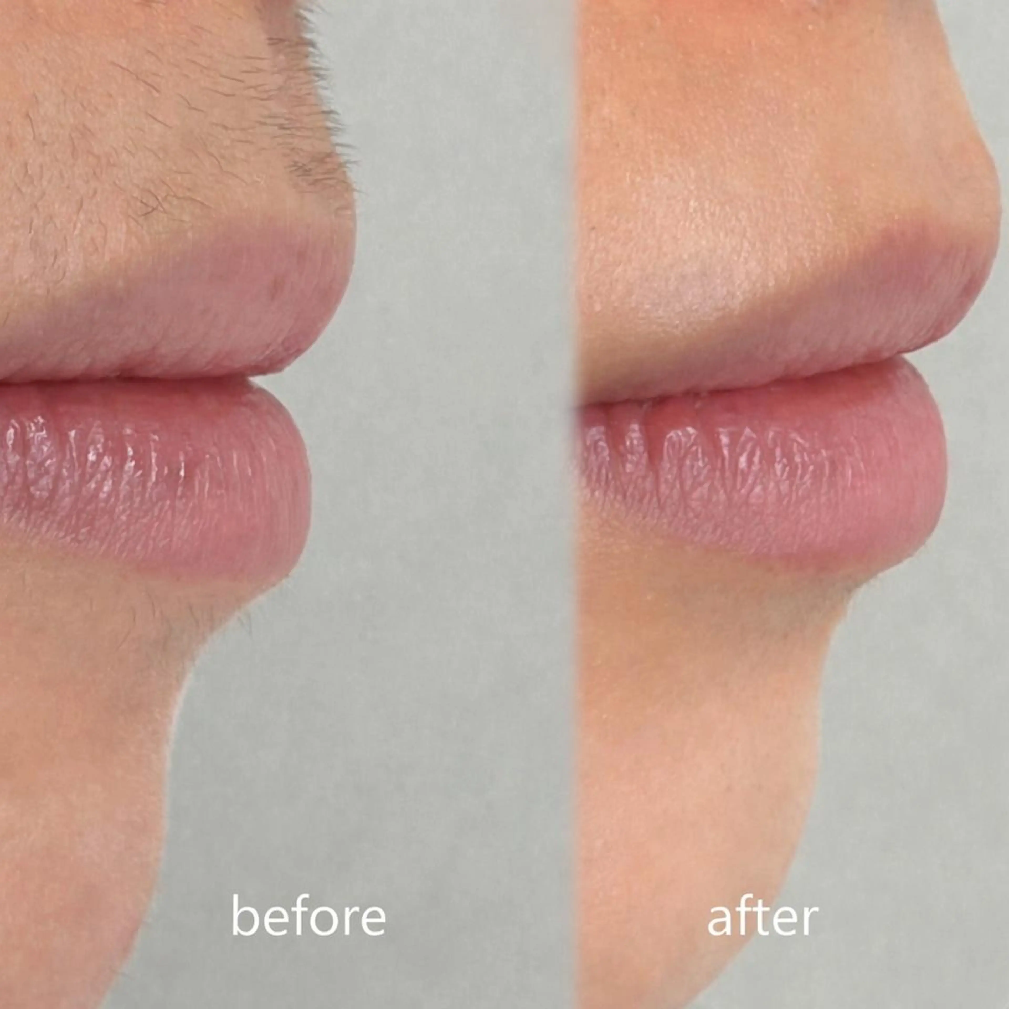 口周りワックス✨の写真