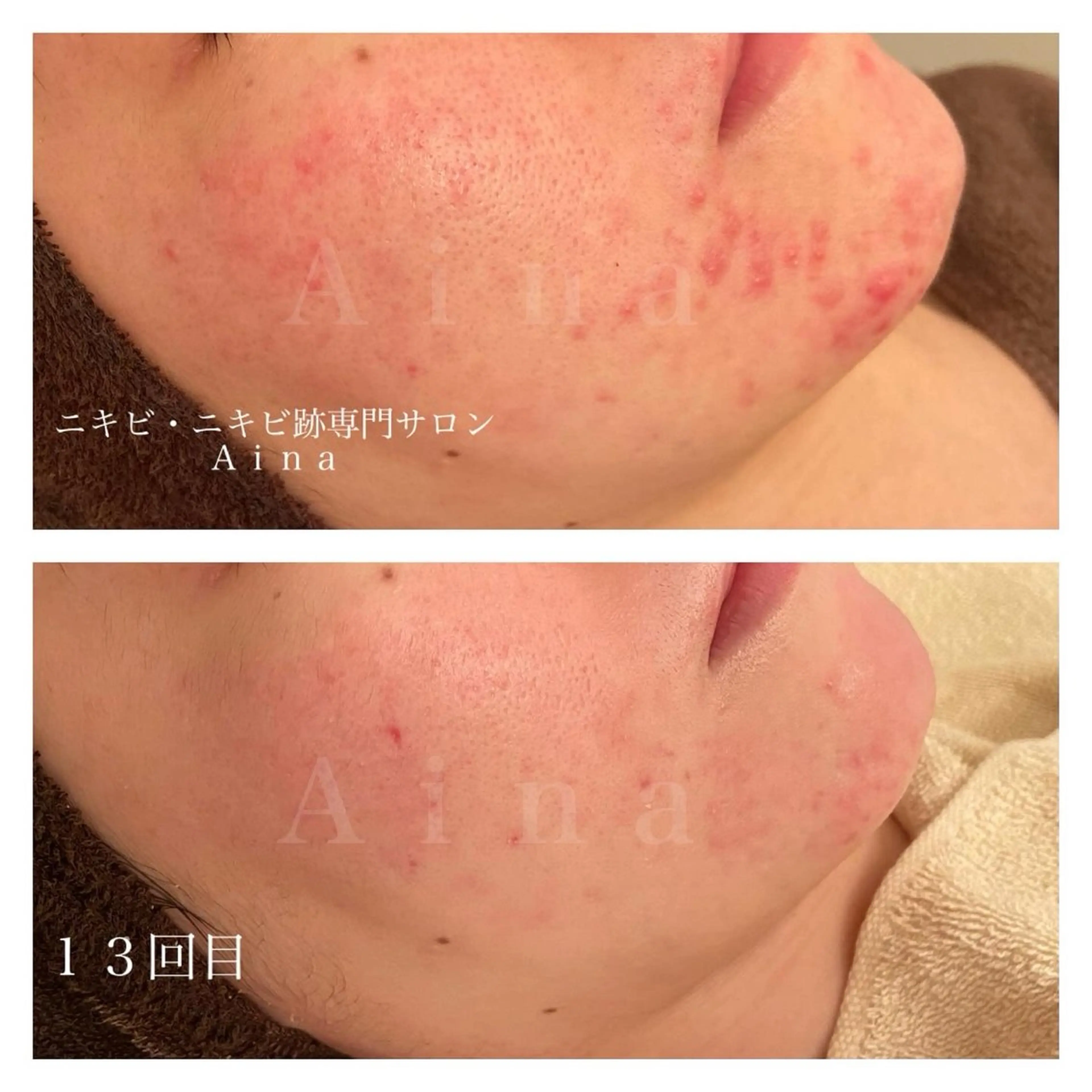 エステ リラク ニキビ跡専門サロン Ainaのエステ・リラクイメージ