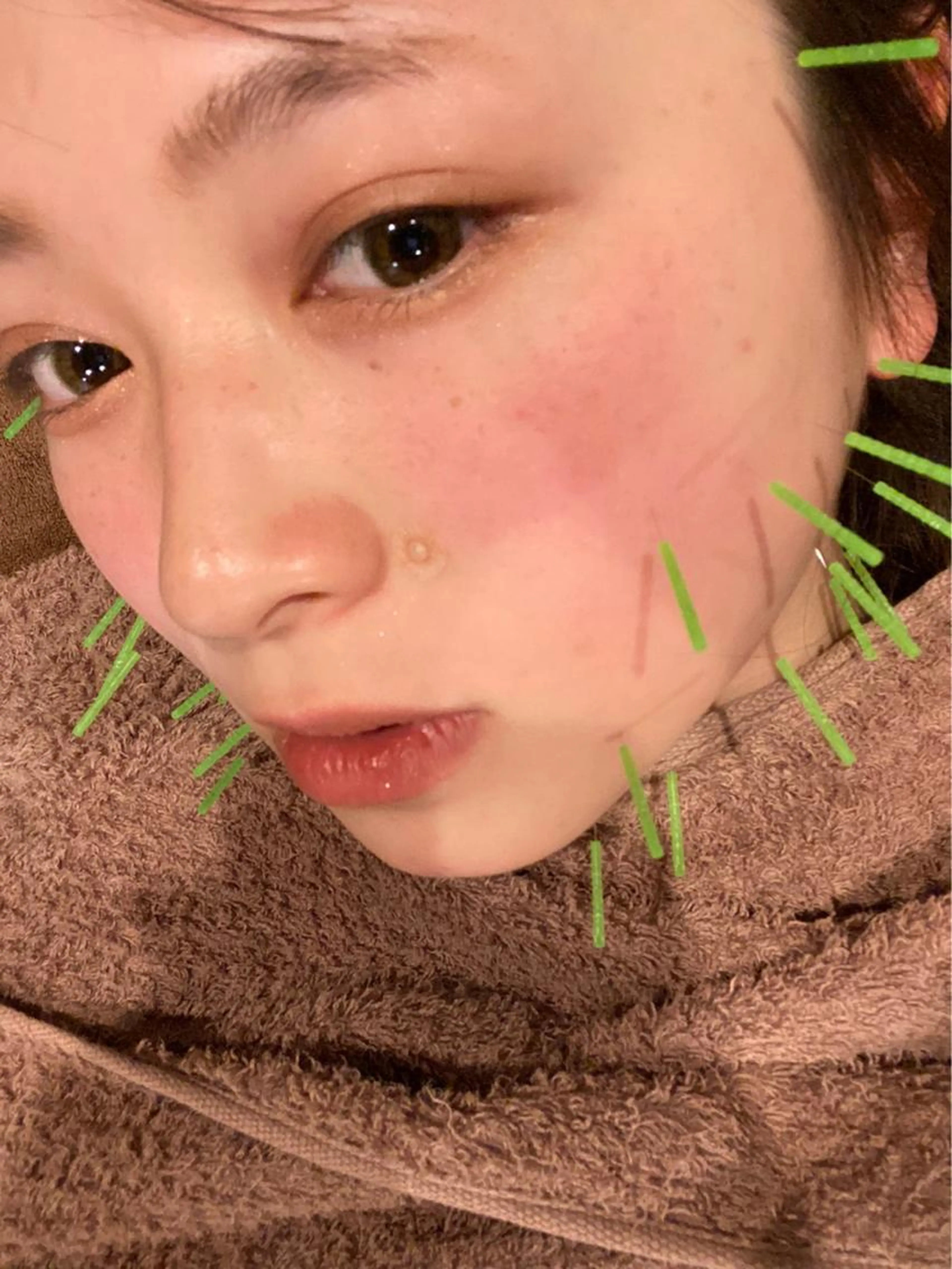 ミニモ限定⭐️美容鍼(顔のみ)⭐️の写真