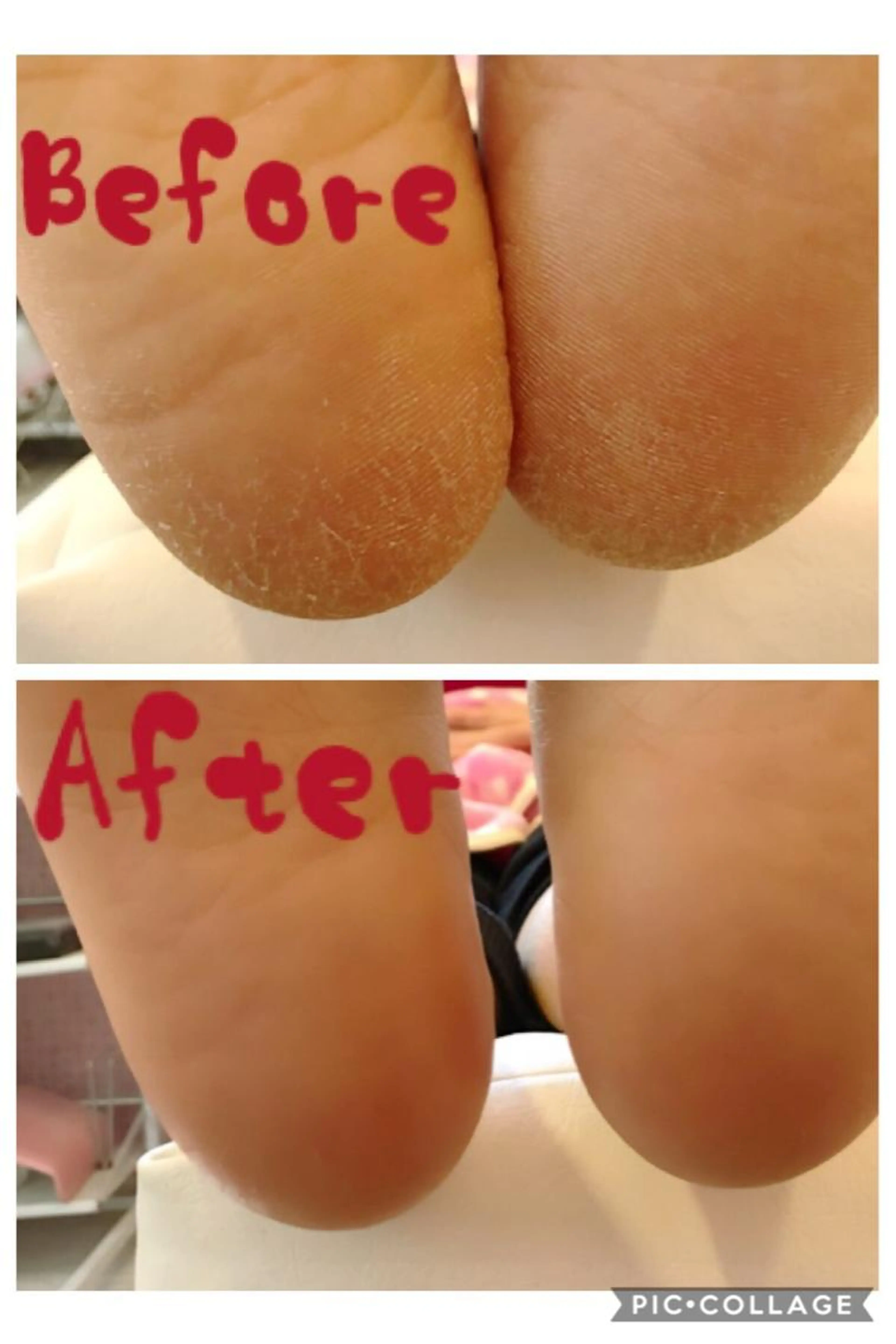 フット角質ケアの写真