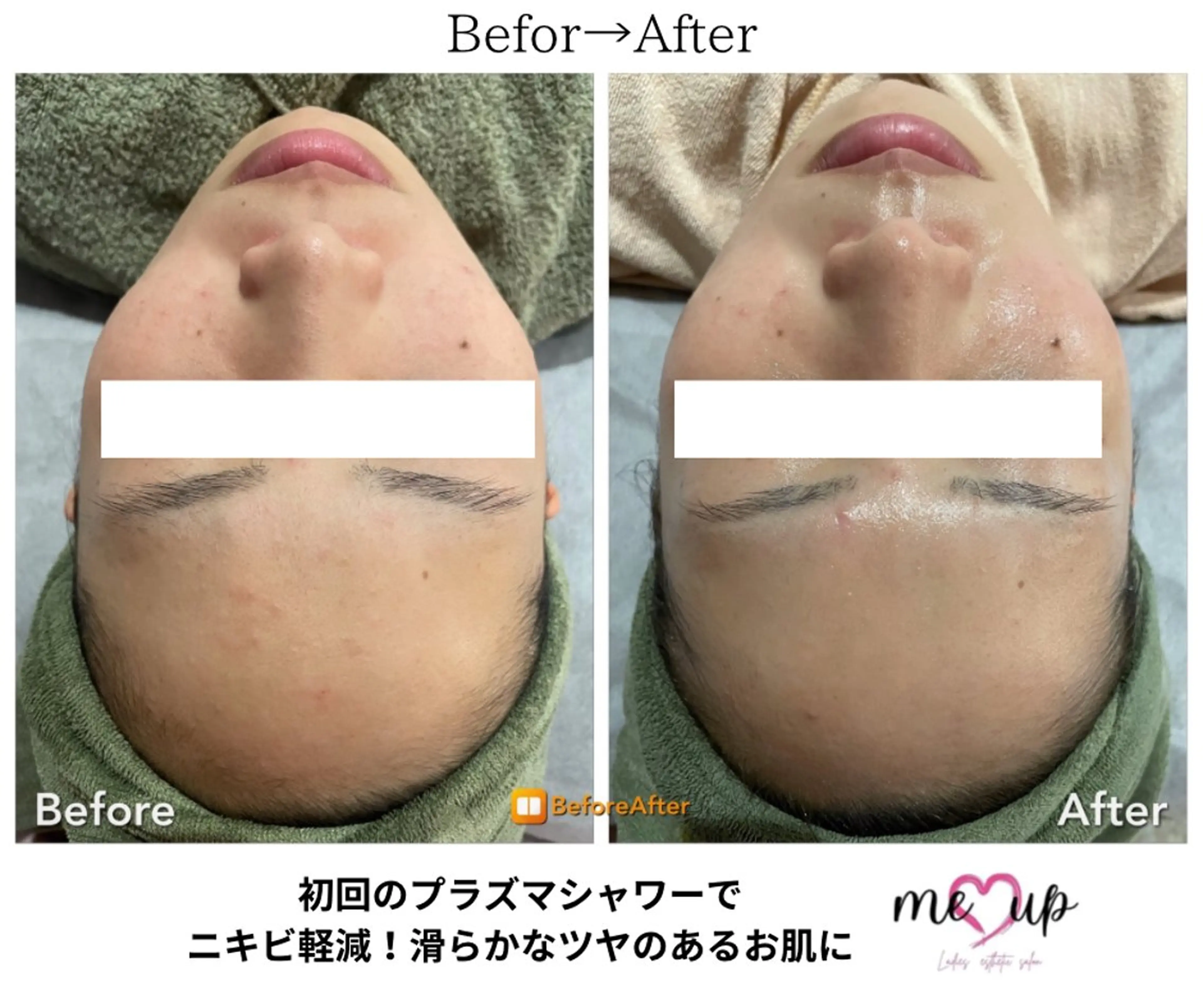 エステ Meupニキビ専門店 背中/ハーブ/肌管理のその他イメージ