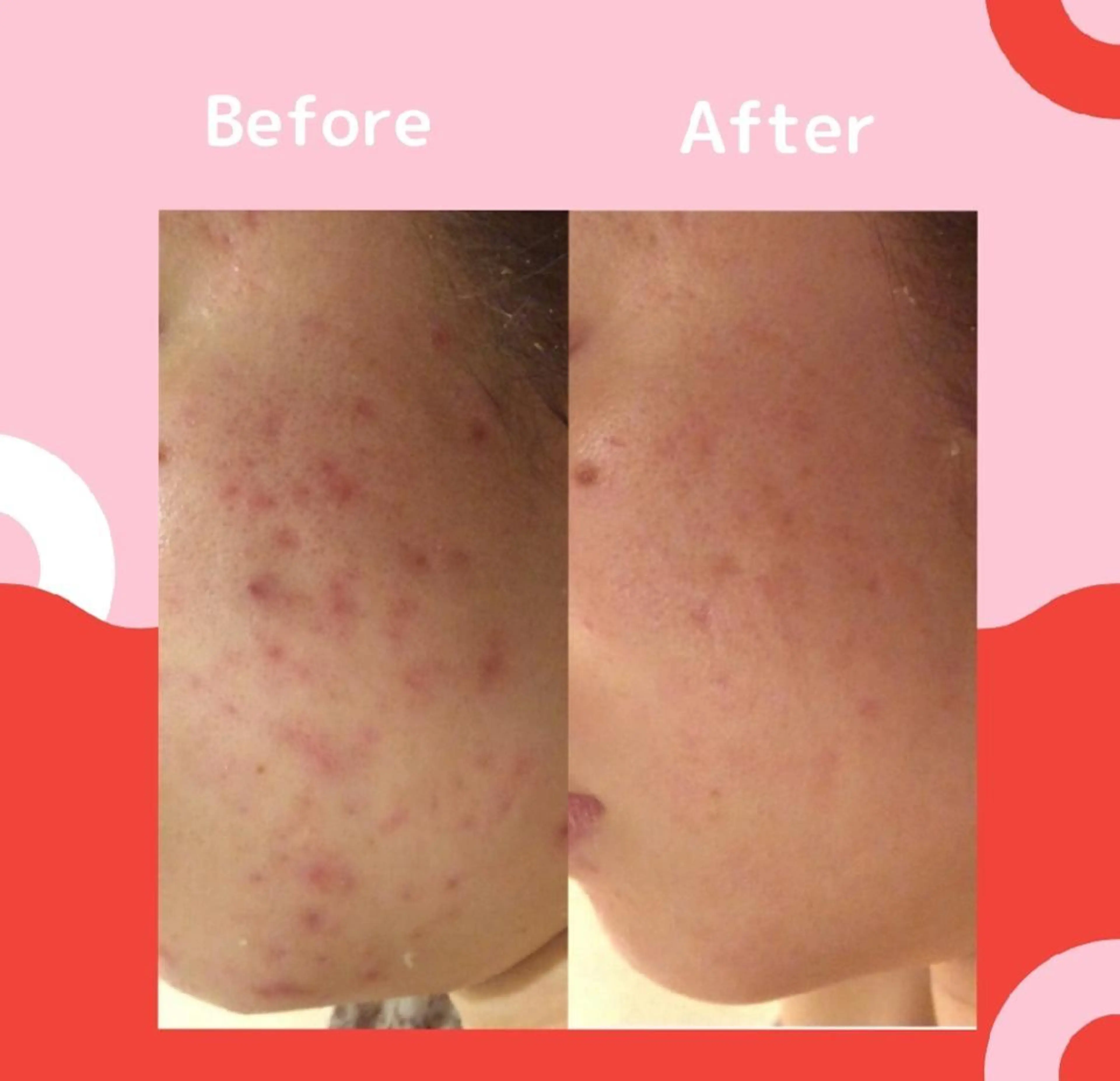 🔥3か月で肌革命 🔥ニキビ専門店のエステ・リラクイメージ