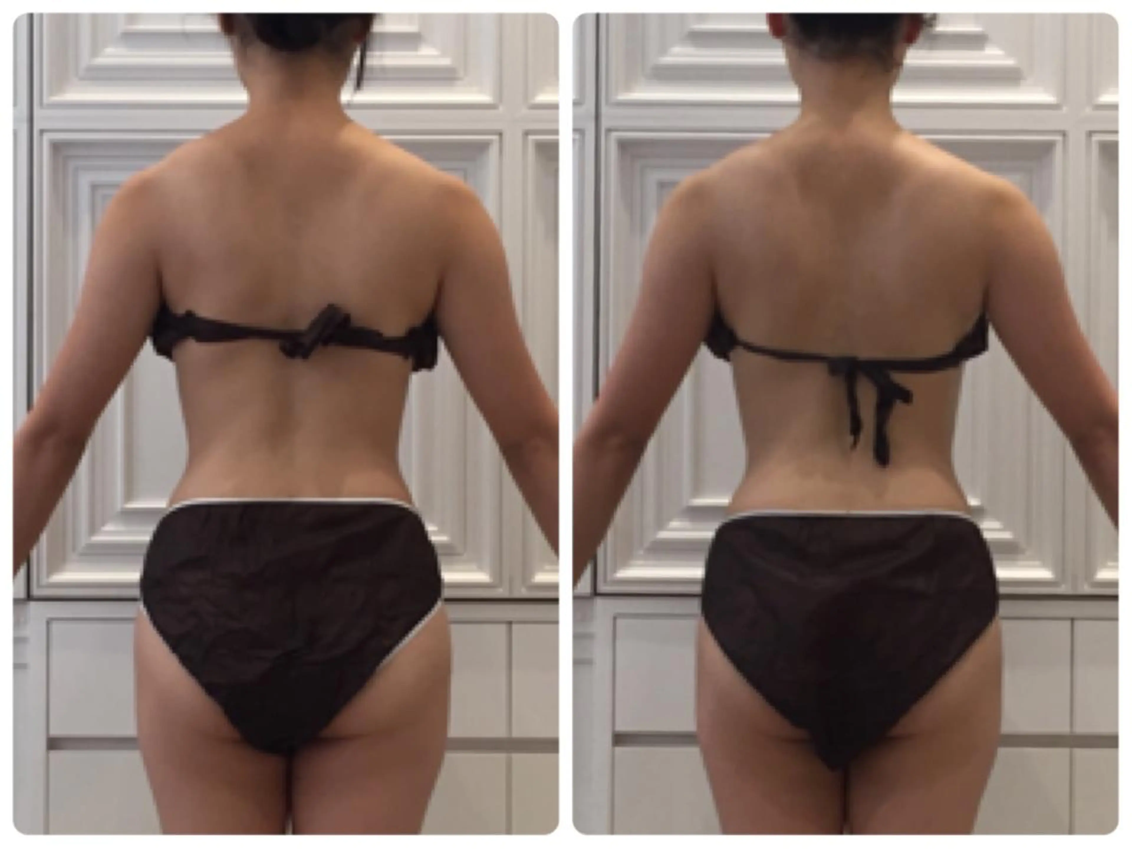 【上半身痩せ👙】キャビ＋ラジオ波＋マッサージ60分✨で気になる脂肪撃退✨の写真