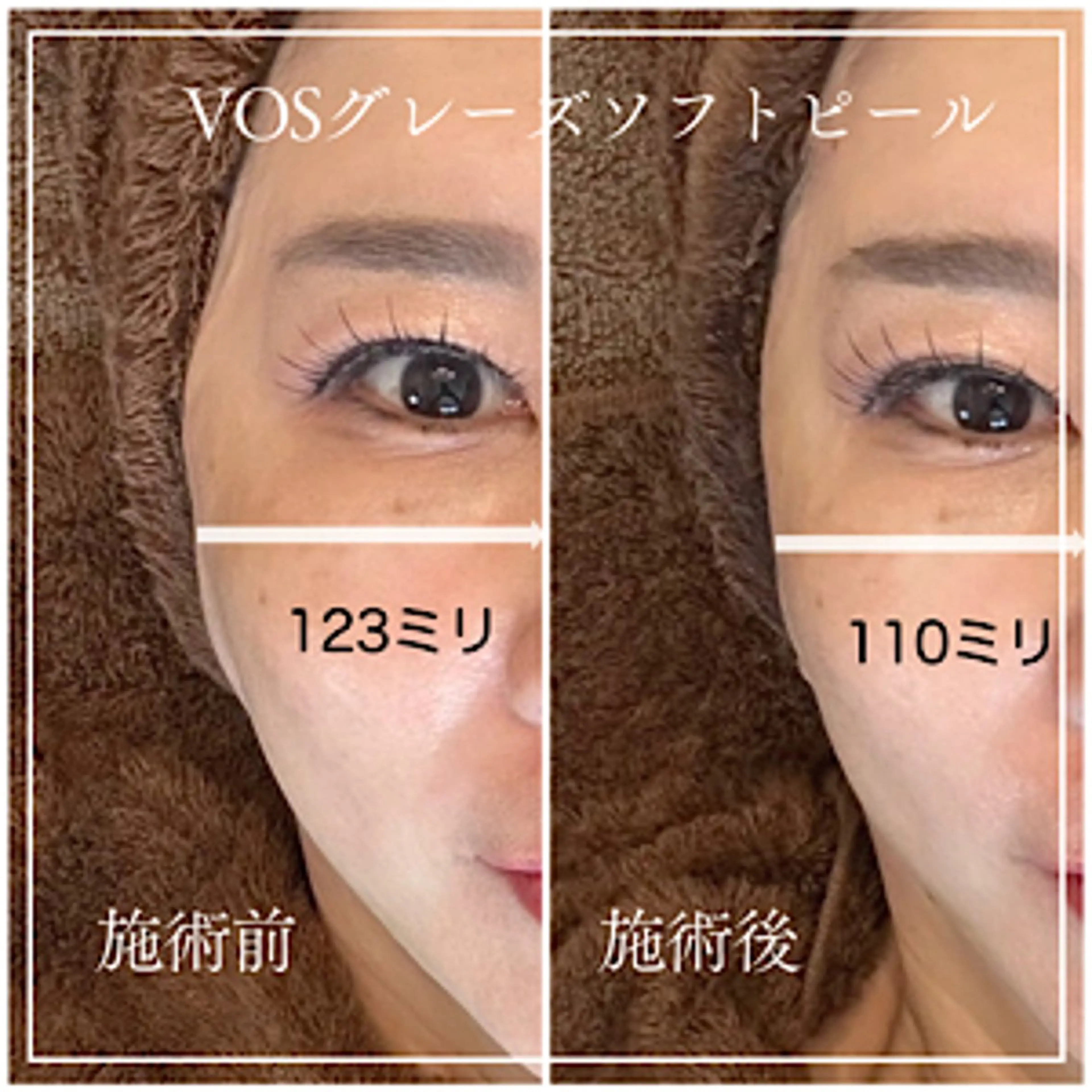 【初回】VOSグレーズソフトピーリング　ニキビ、乾燥、ムクミ、小顔の写真