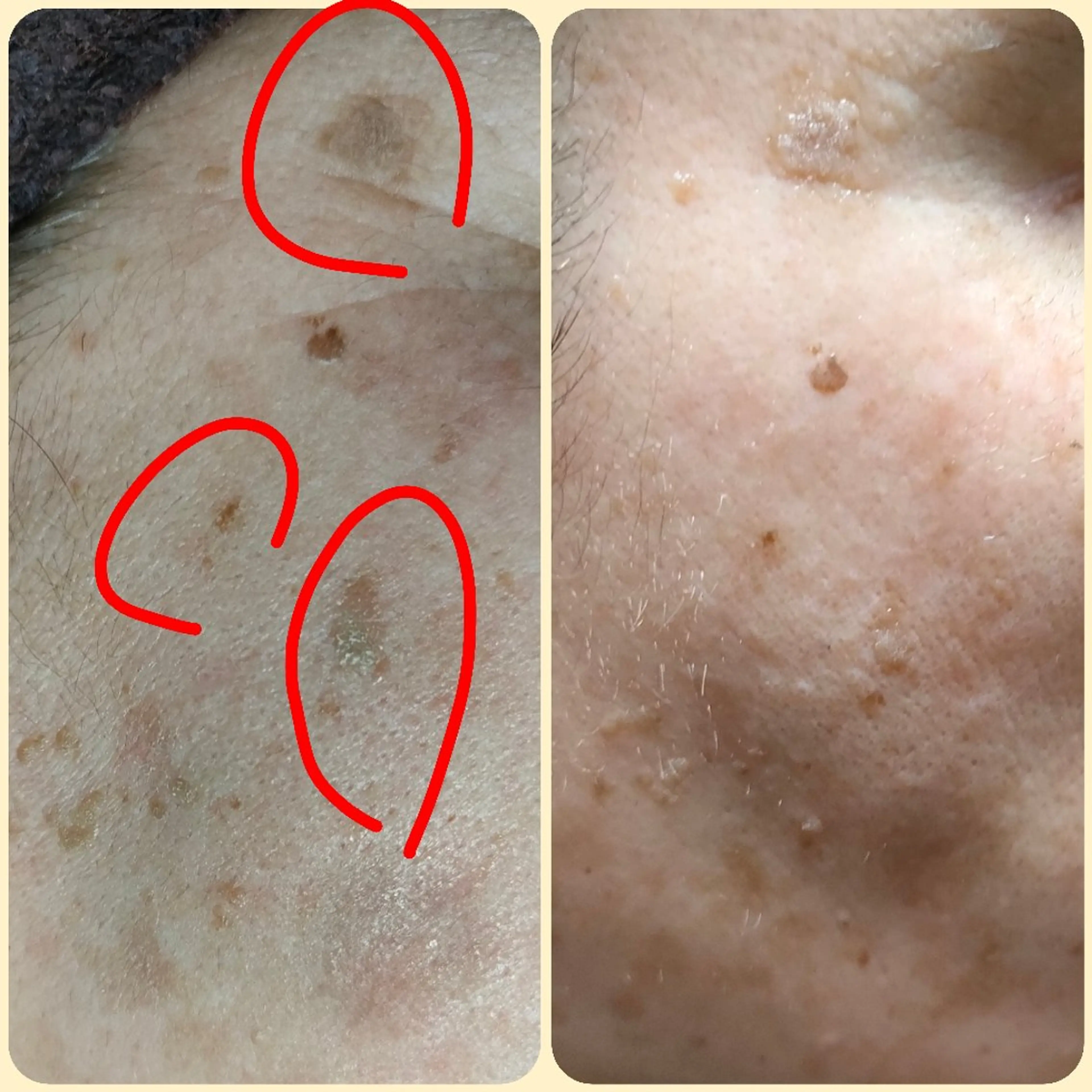 シミ・肝斑ケア！プラズマ+トラネキサム酸ポレーション導入の写真