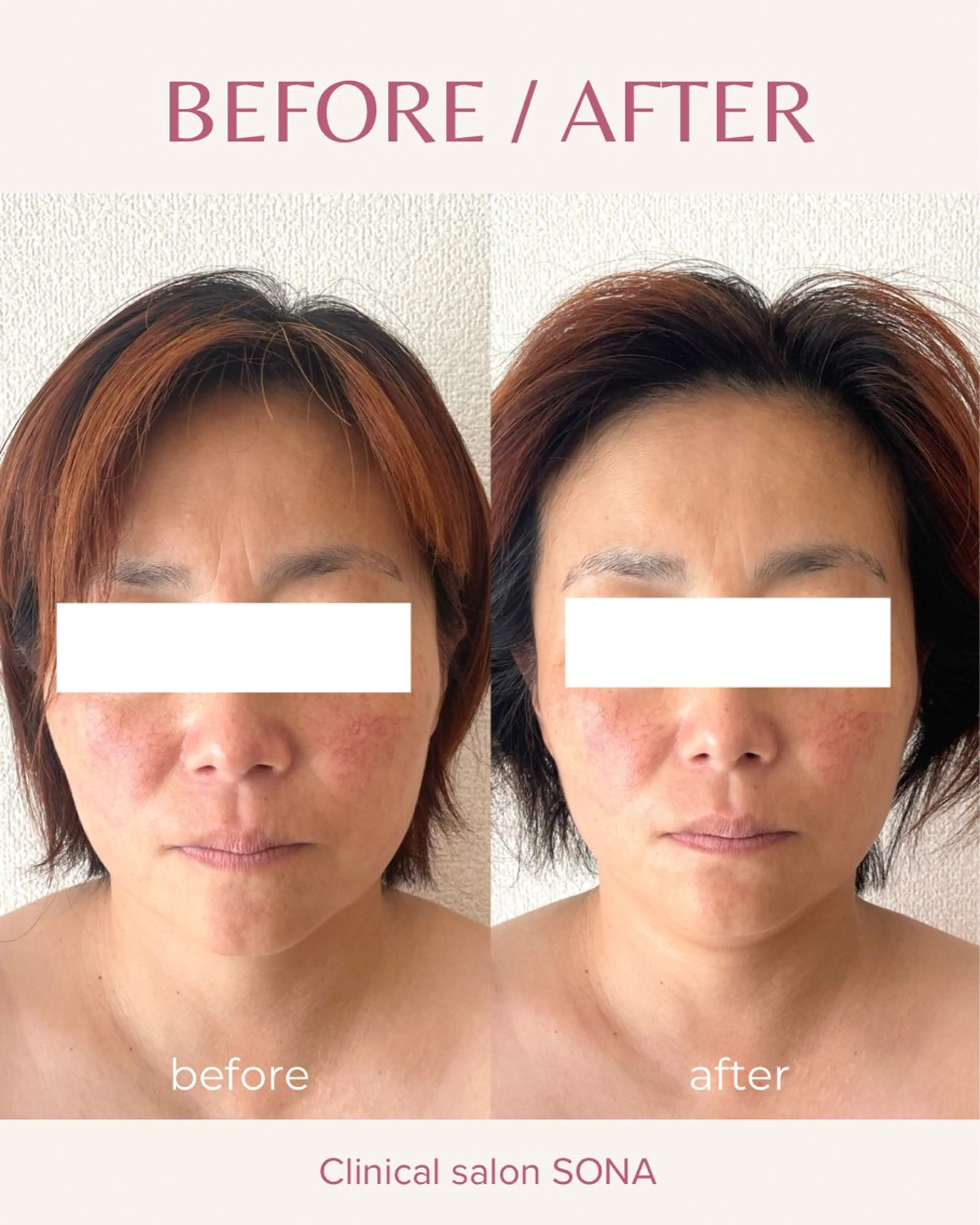 エステ 小顔/たるみ/黒ずみ除去専門サロン/SONA 大和西大寺店所属・【小顔専門看護師 サロンSONA】のエステ・リラクイメージ