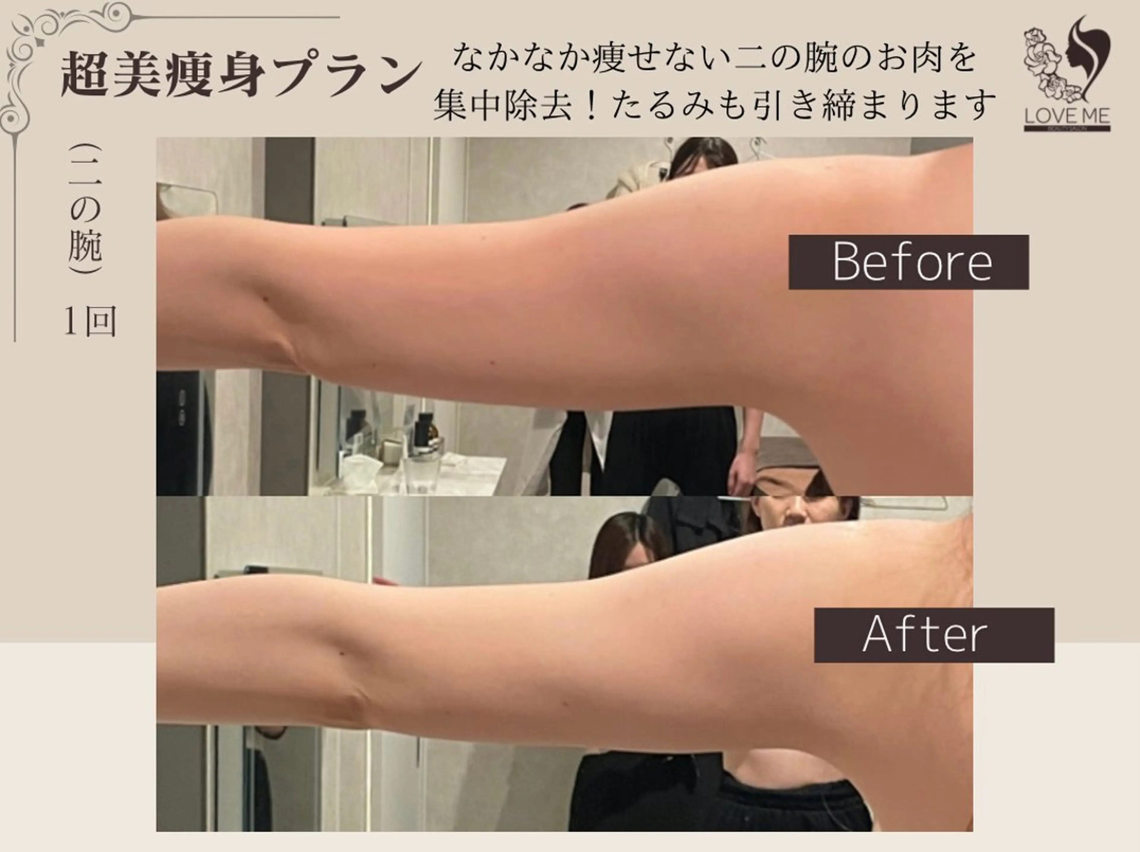 《二の腕大人気》蓄熱式超音波マシン※無制限ショット数&EMS付き11200円の写真