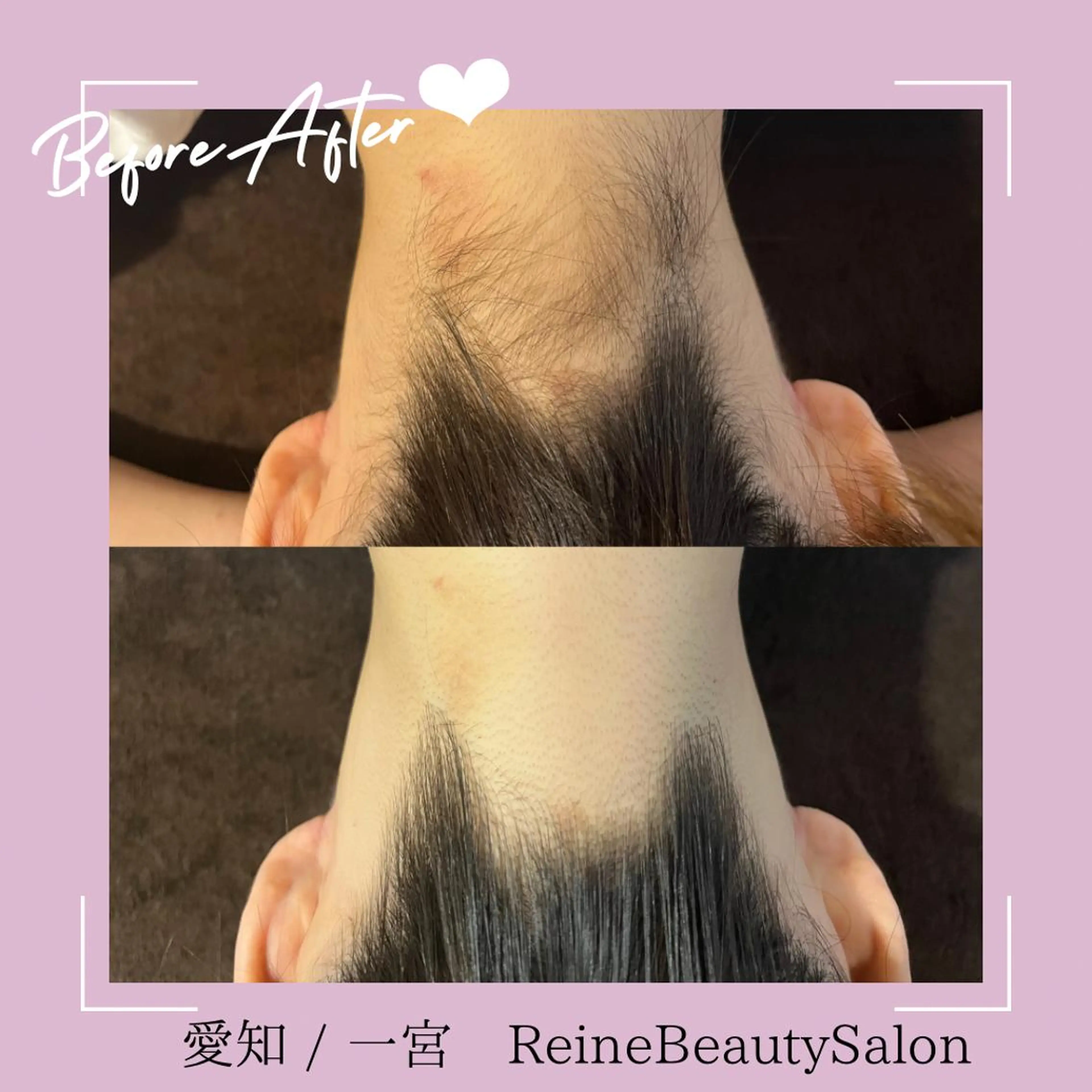 脱毛 Reine BeautySalon所属・毛穴/シミ肝斑/脱毛 横山梨里のエステ・リラクイメージ