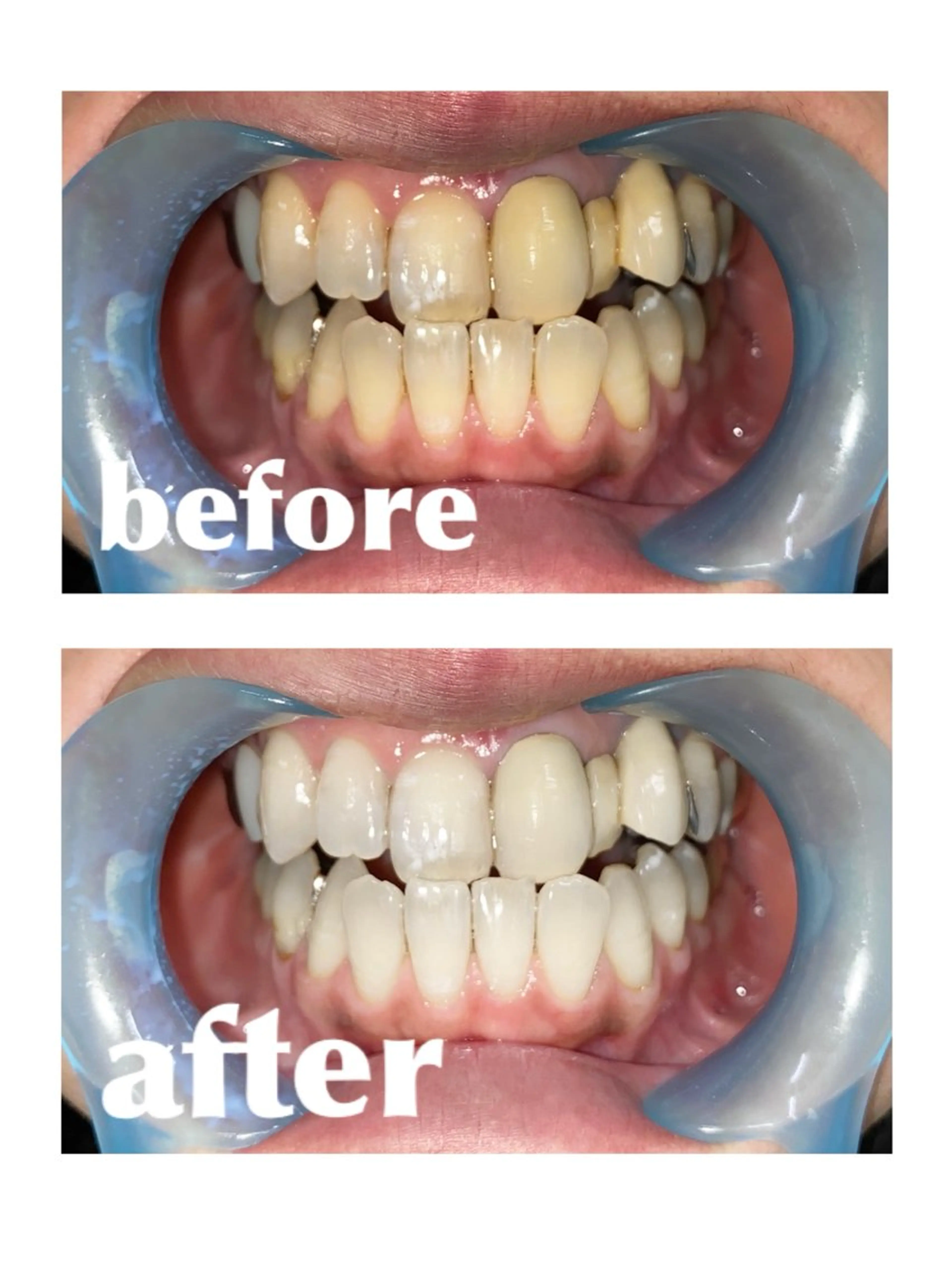 セルフホワイトニング15分の写真