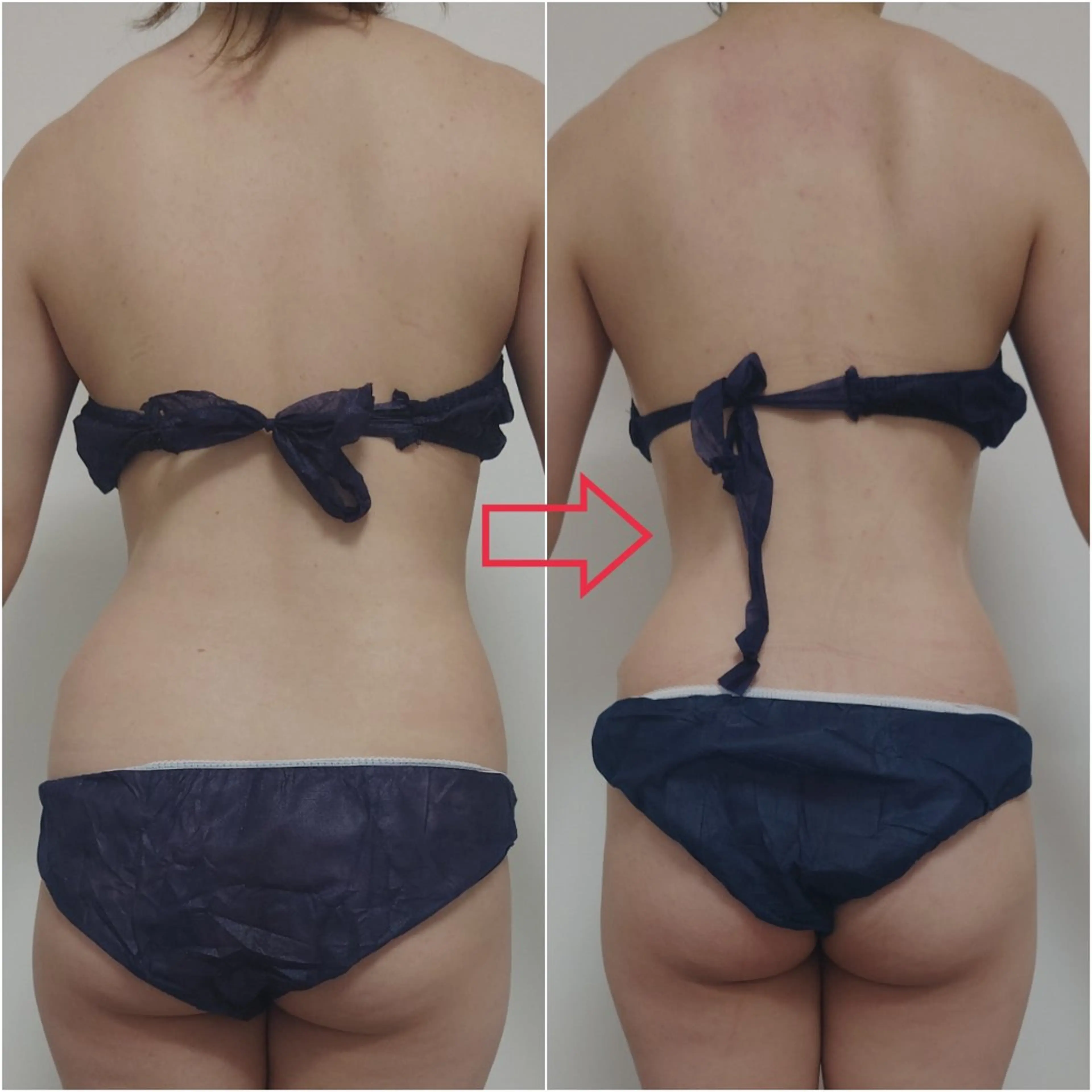 🉐【痩身人気No.1】今すぐ痩せたい！綺麗になりたい方✨ハイパーナイフ痩身100分×3回※条件アリの写真