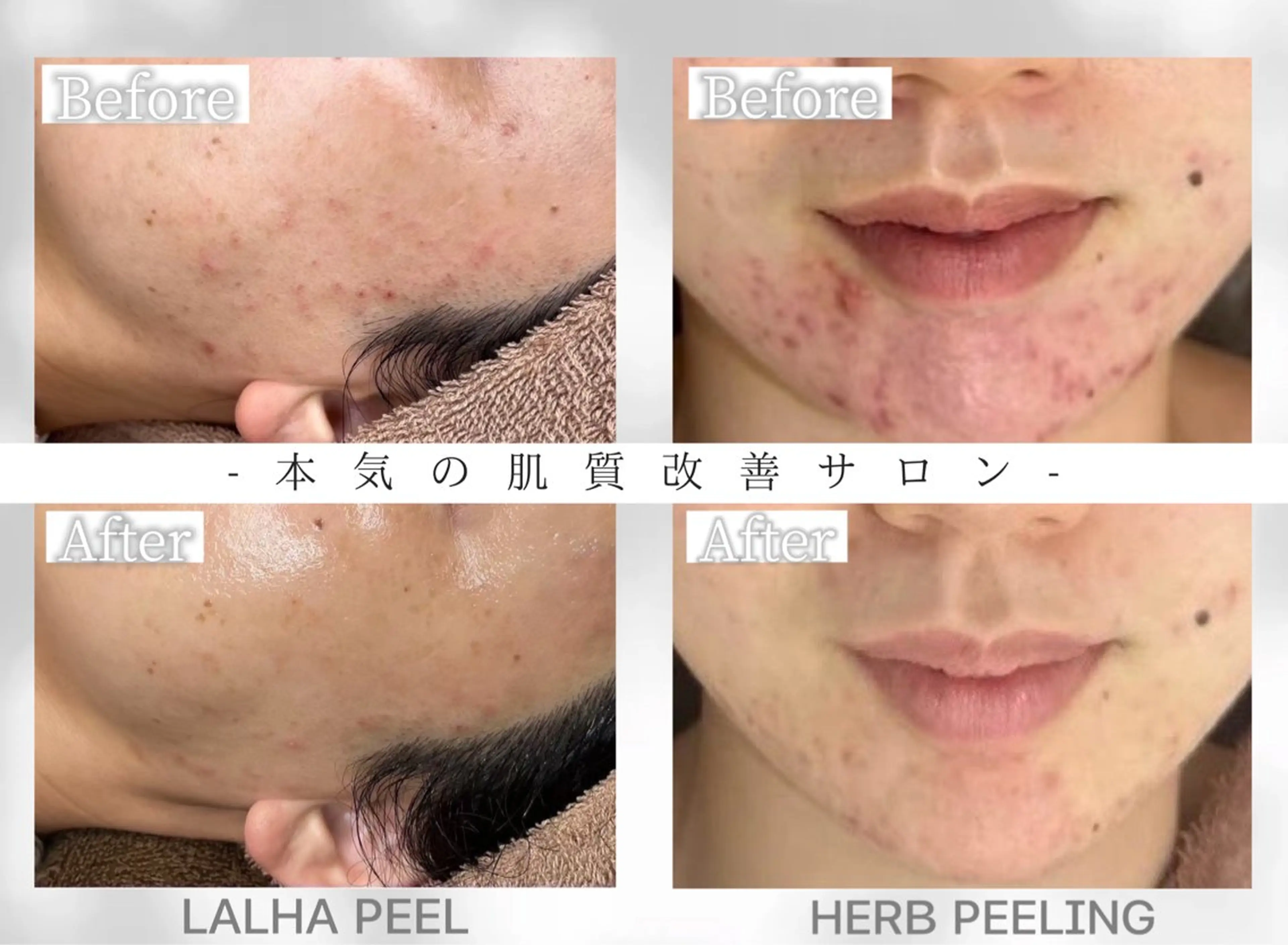 毛穴・ニキビケア ハーブピーリング【肌管理専門店】WHITE AQUA鳳店所属・ホワイトアクア 鳳店のエステ・リラクイメージ