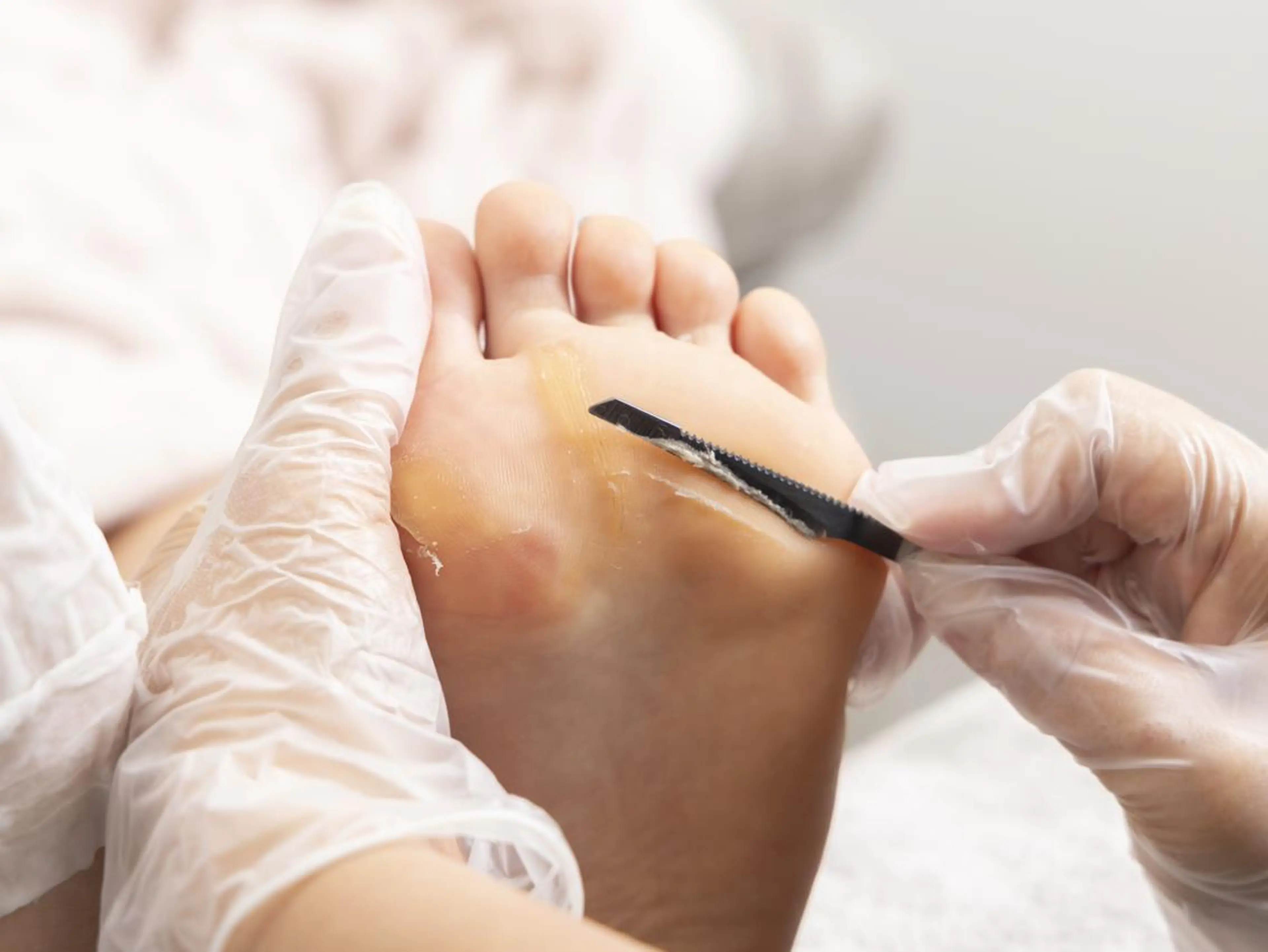 フットケア＊角質除去　✨✨スペシャルケア✨✨の写真