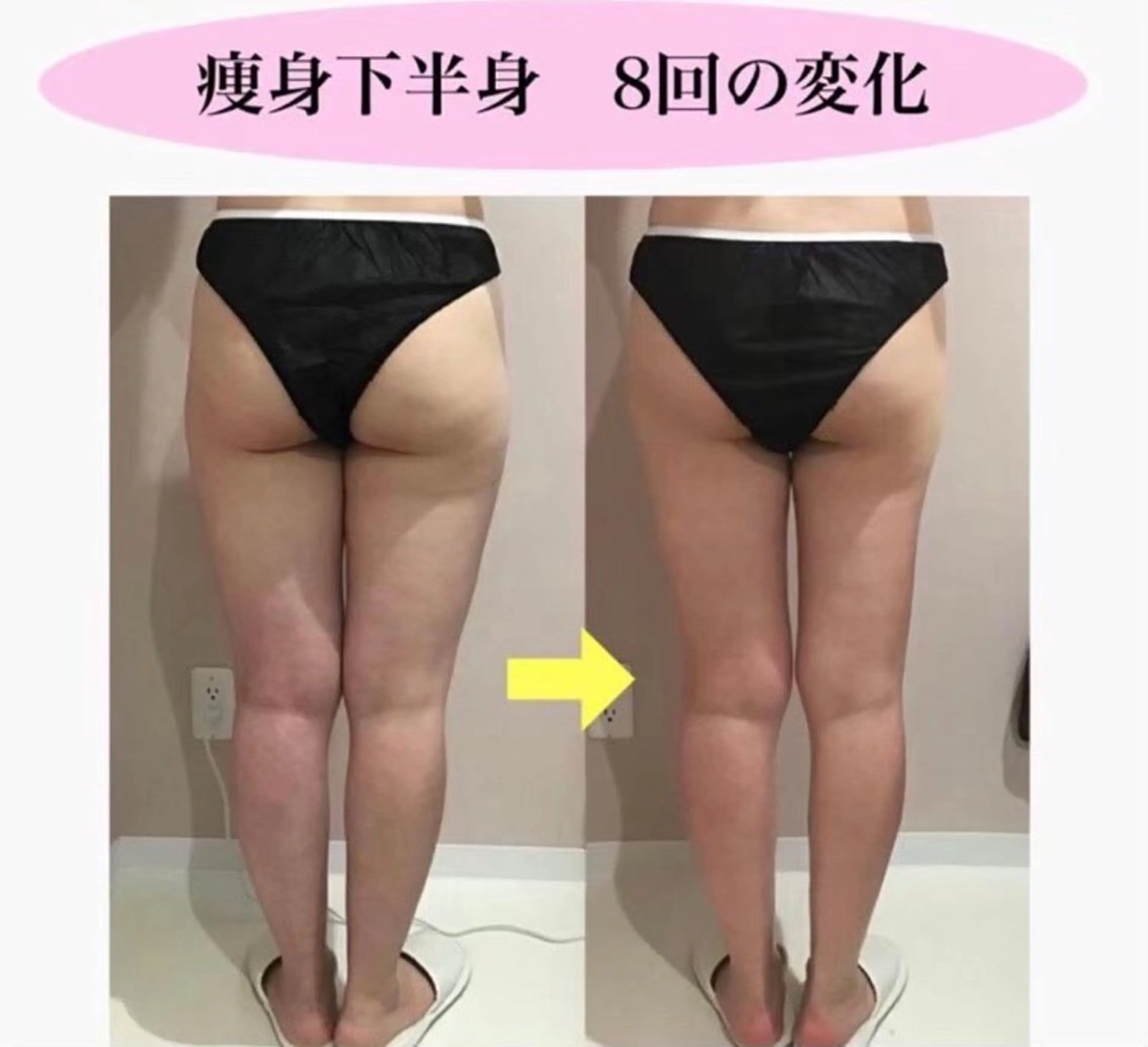 【痩身】【太もも･お尻 】ヒップアップ美尻を目指したい方🍑引き上げながらガッツリ施術🔥キャビ/ラジオ波/吸引/EMSの写真