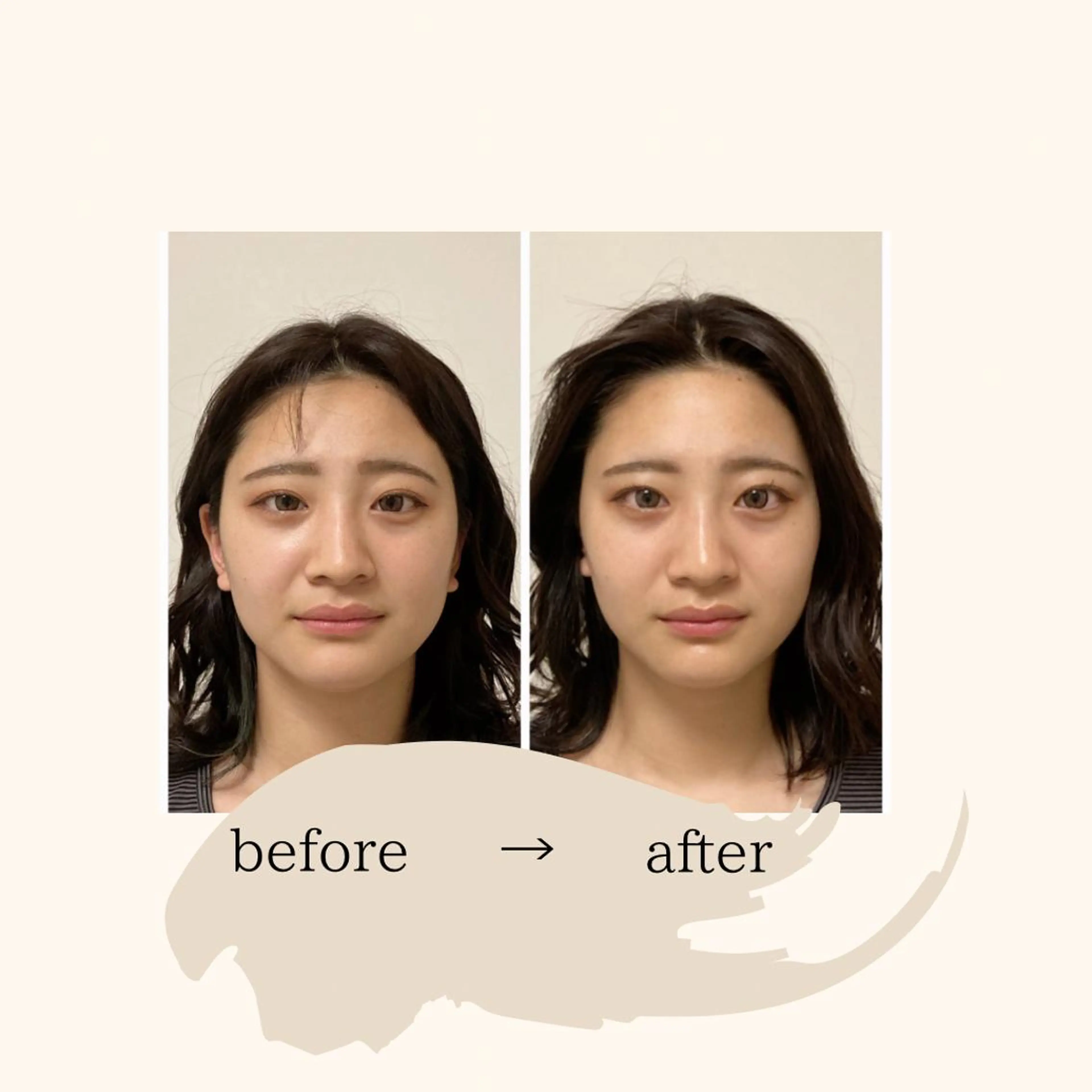 ✨人気no.1✨　　　　　　　　　　　　　　　　　　　美容鍼&整体のトータルケアコースの写真