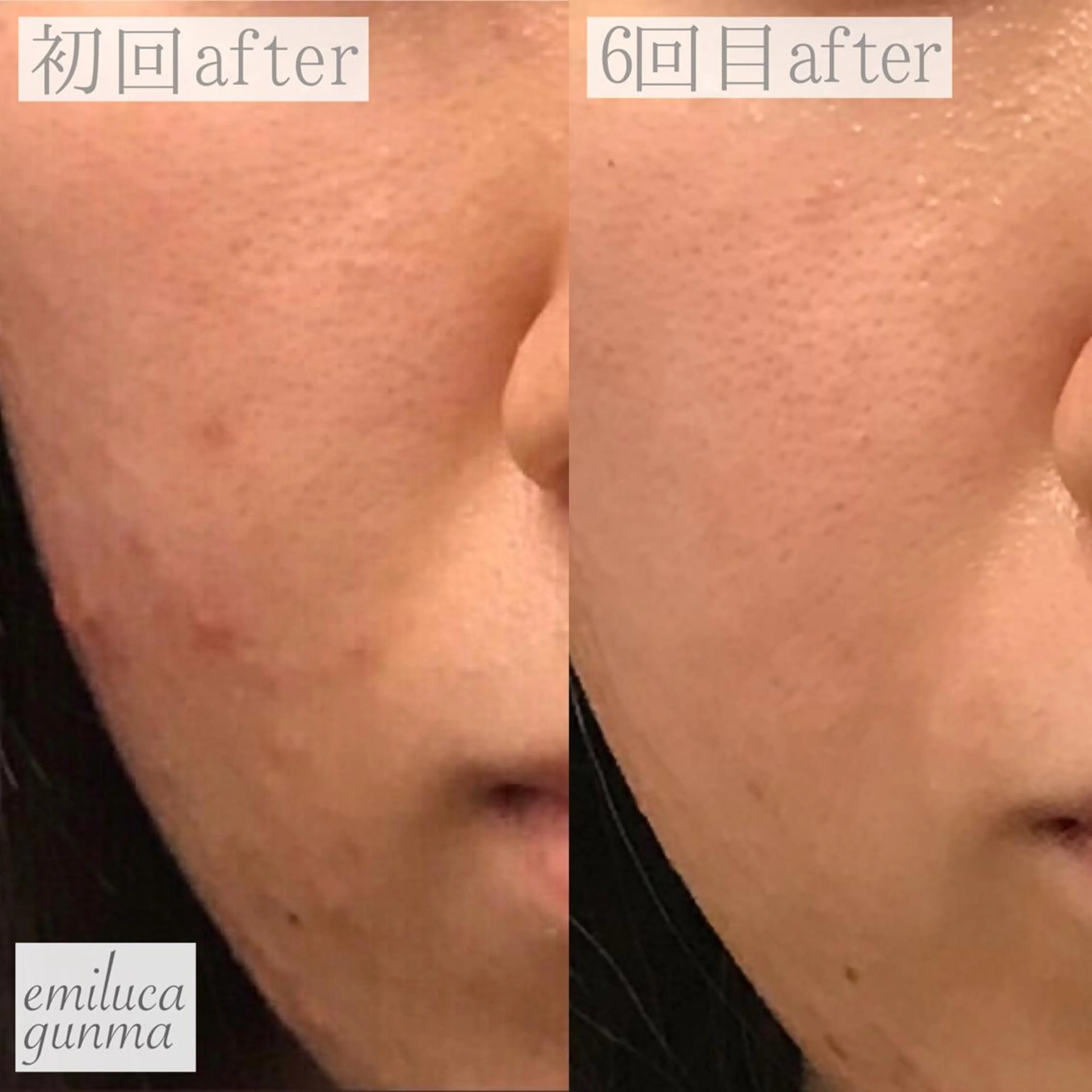 emiluca西目/ 毛穴洗浄/細胞美容のエステ・リラクイメージ