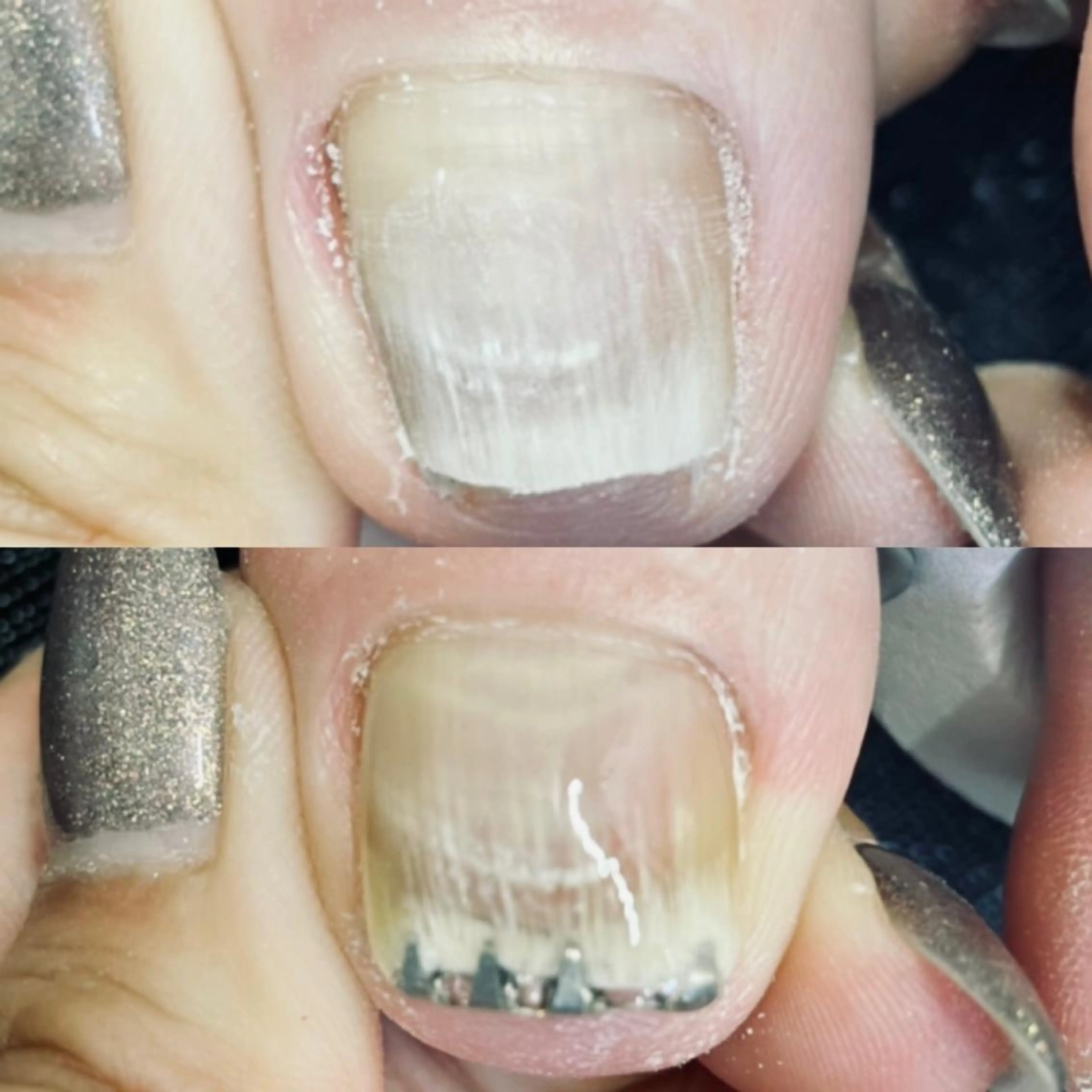 ワイヤーを使った巻爪矯正✨ワイヤーで持ち上げるので直ぐに効果を実感☺️の写真