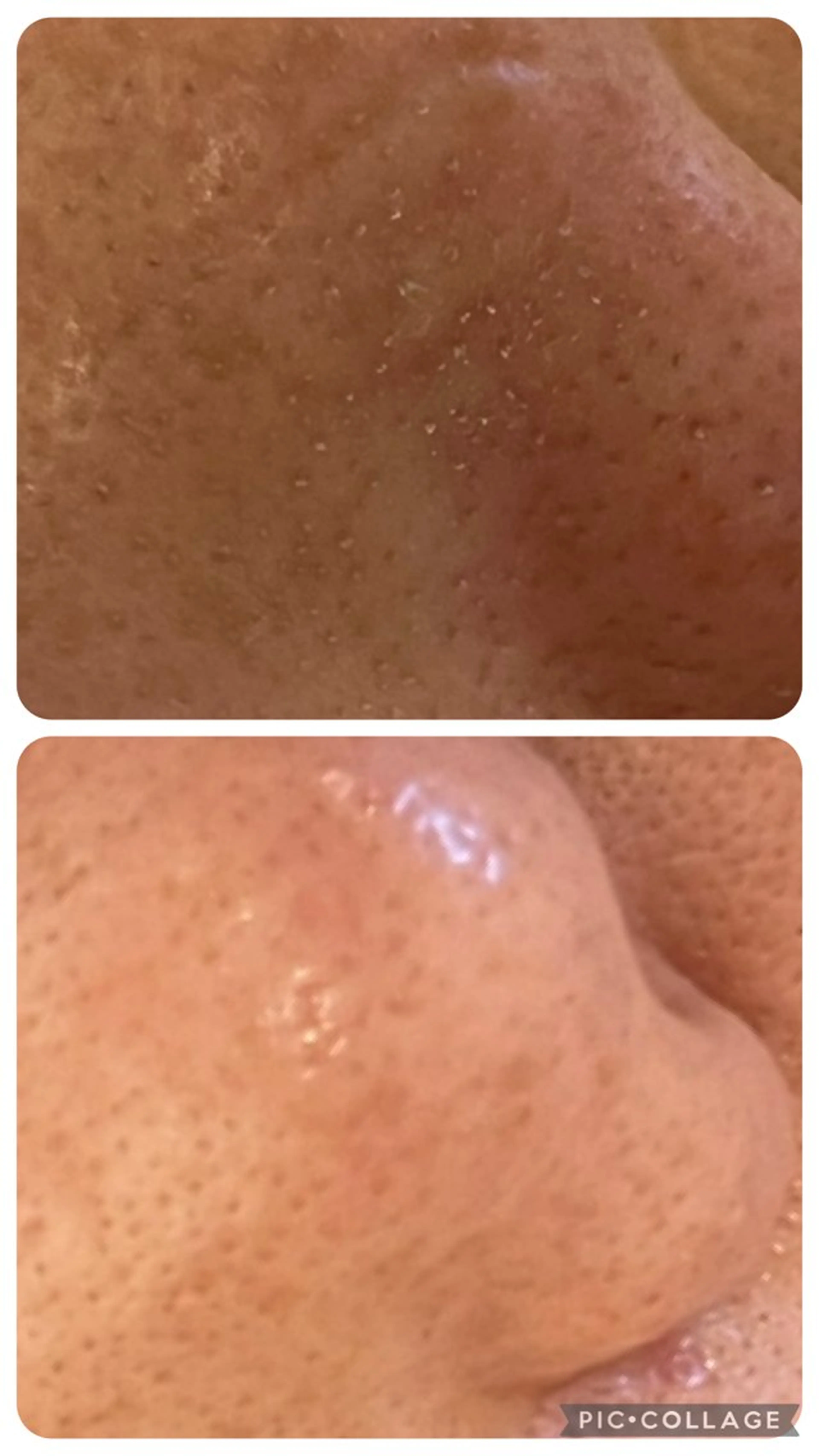 水素毛穴洗浄and小鼻むくみケアの写真