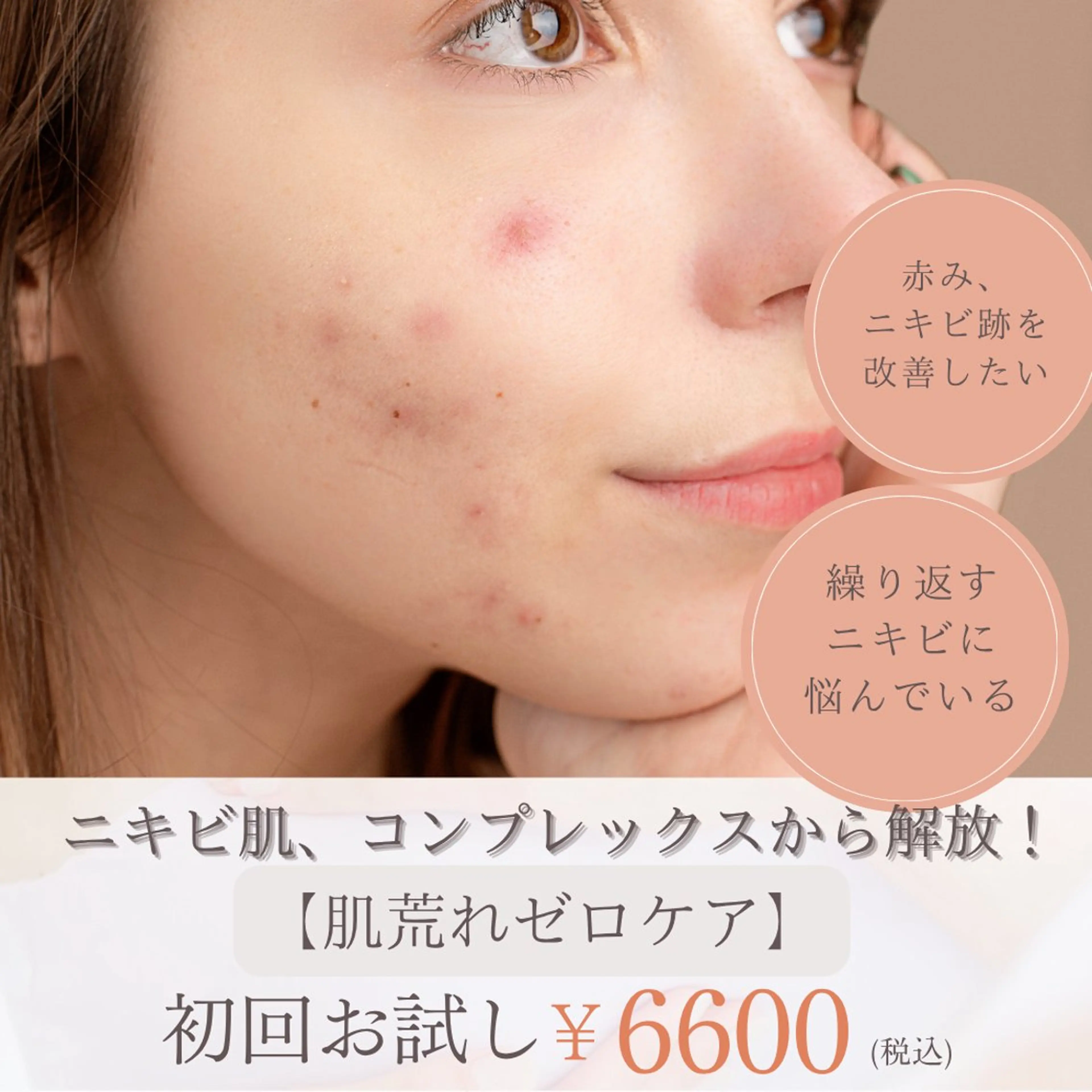 【初回ミニモ特別価格】『ブツブツ・肌荒れから解放』１回目から効果を実感！“肌荒れゼロケア”※初回カウンセリング込みの写真