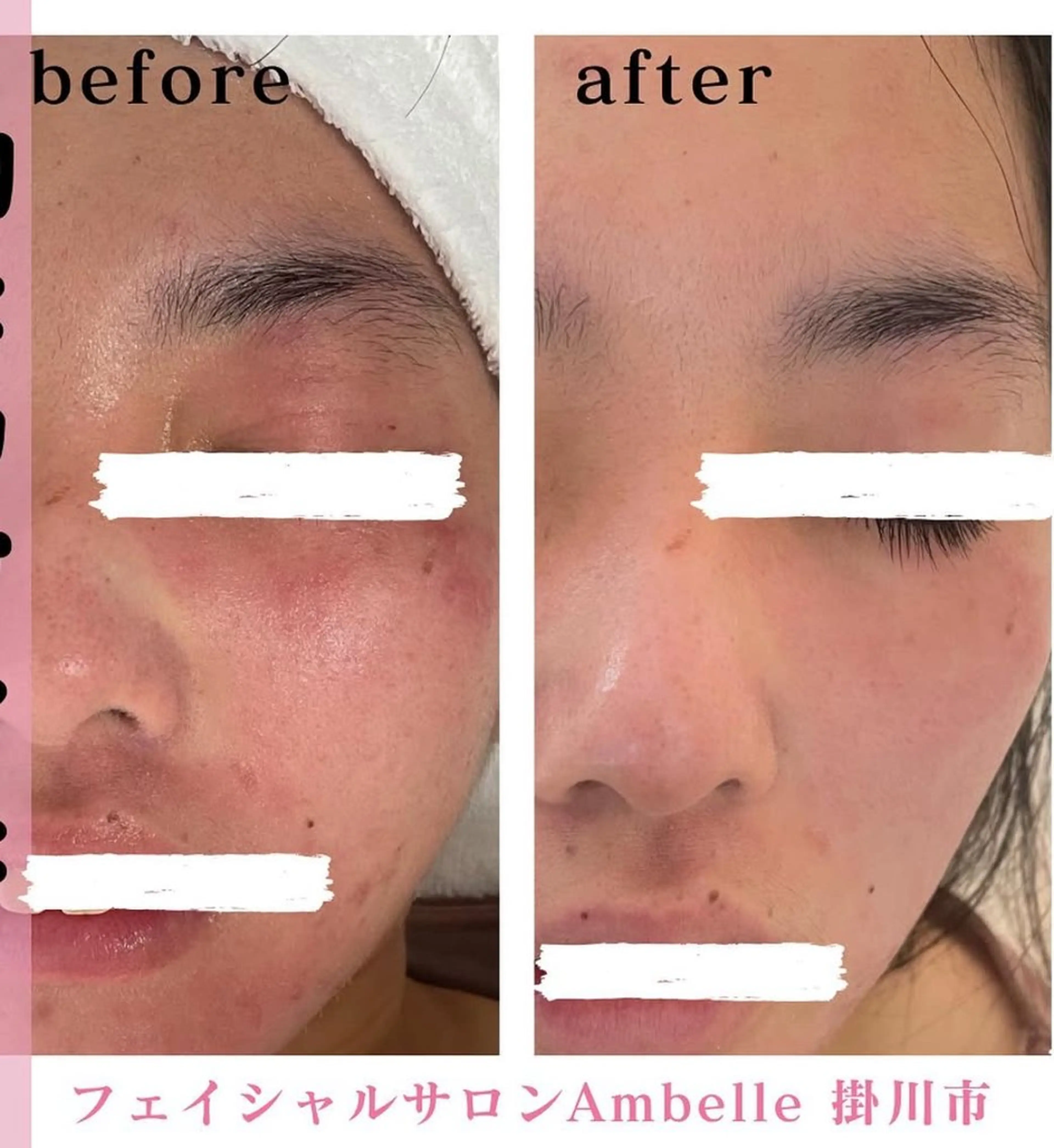 【アトピー肌】【赤み肌】【セラミドお肌に導入】特化コースの写真