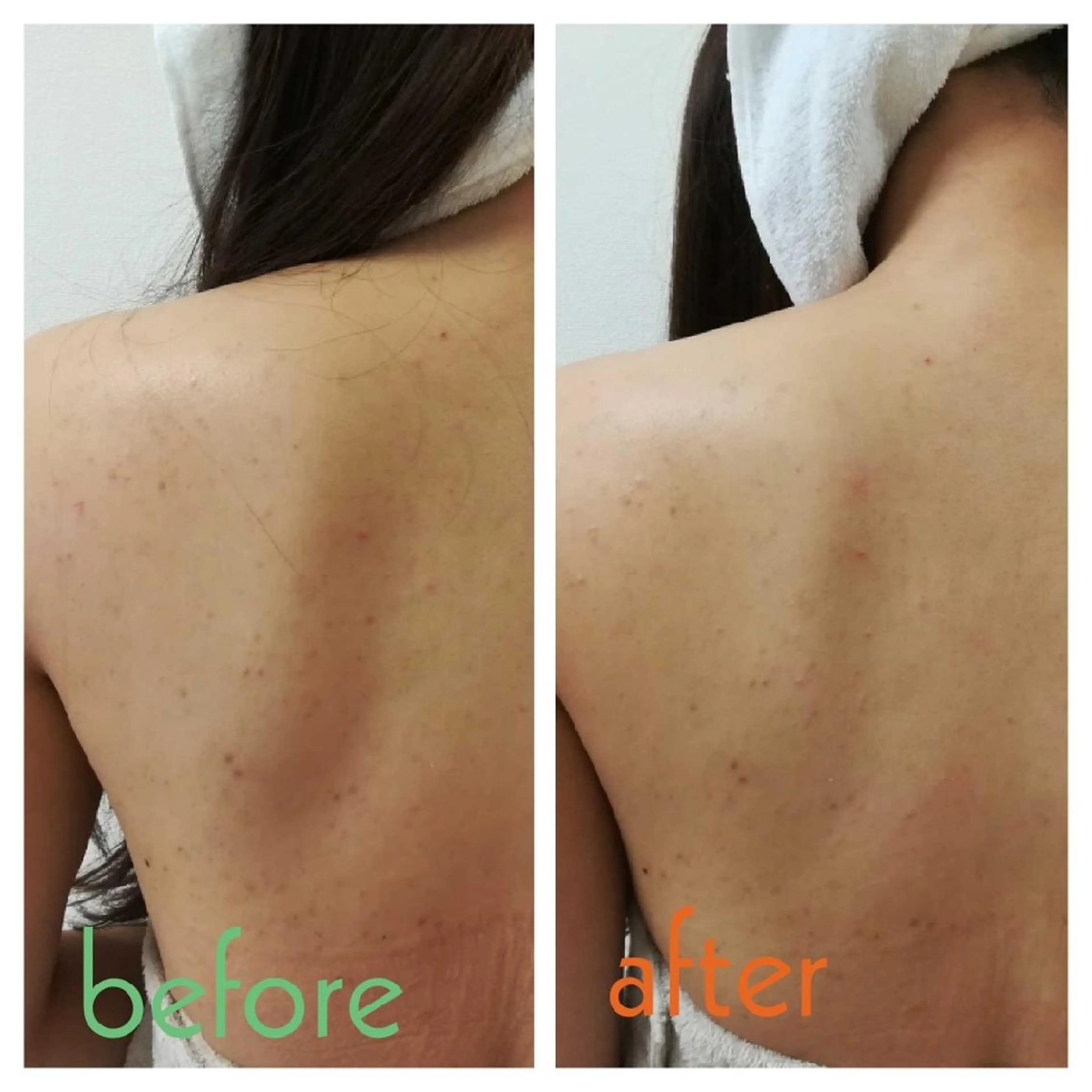 背中のトラブルに！魅せたくなる背中に❤️バックトリートメント✨の写真