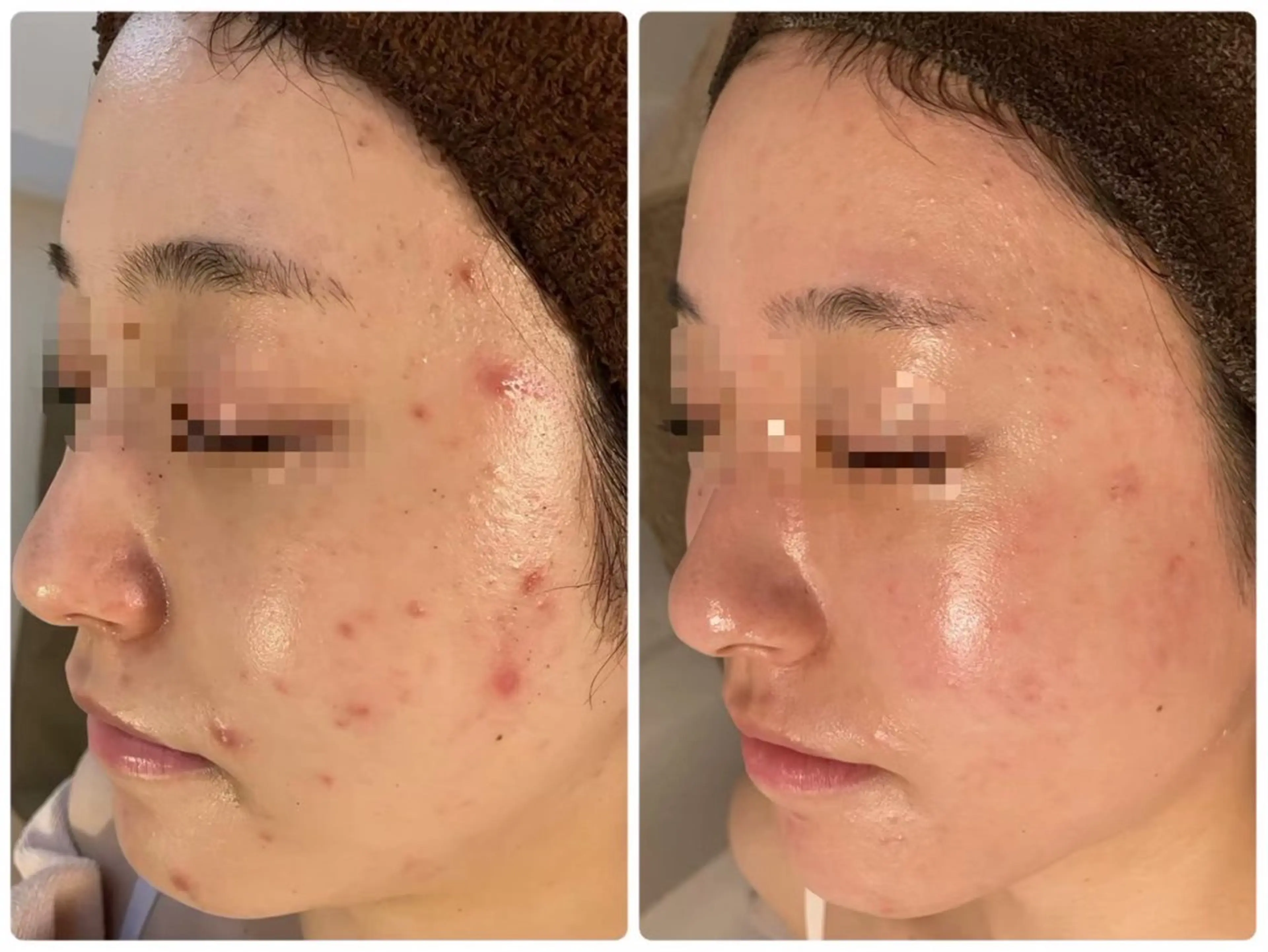 ニキビ･毛穴悩み特化 /CHISATOのエステ・リラクイメージ