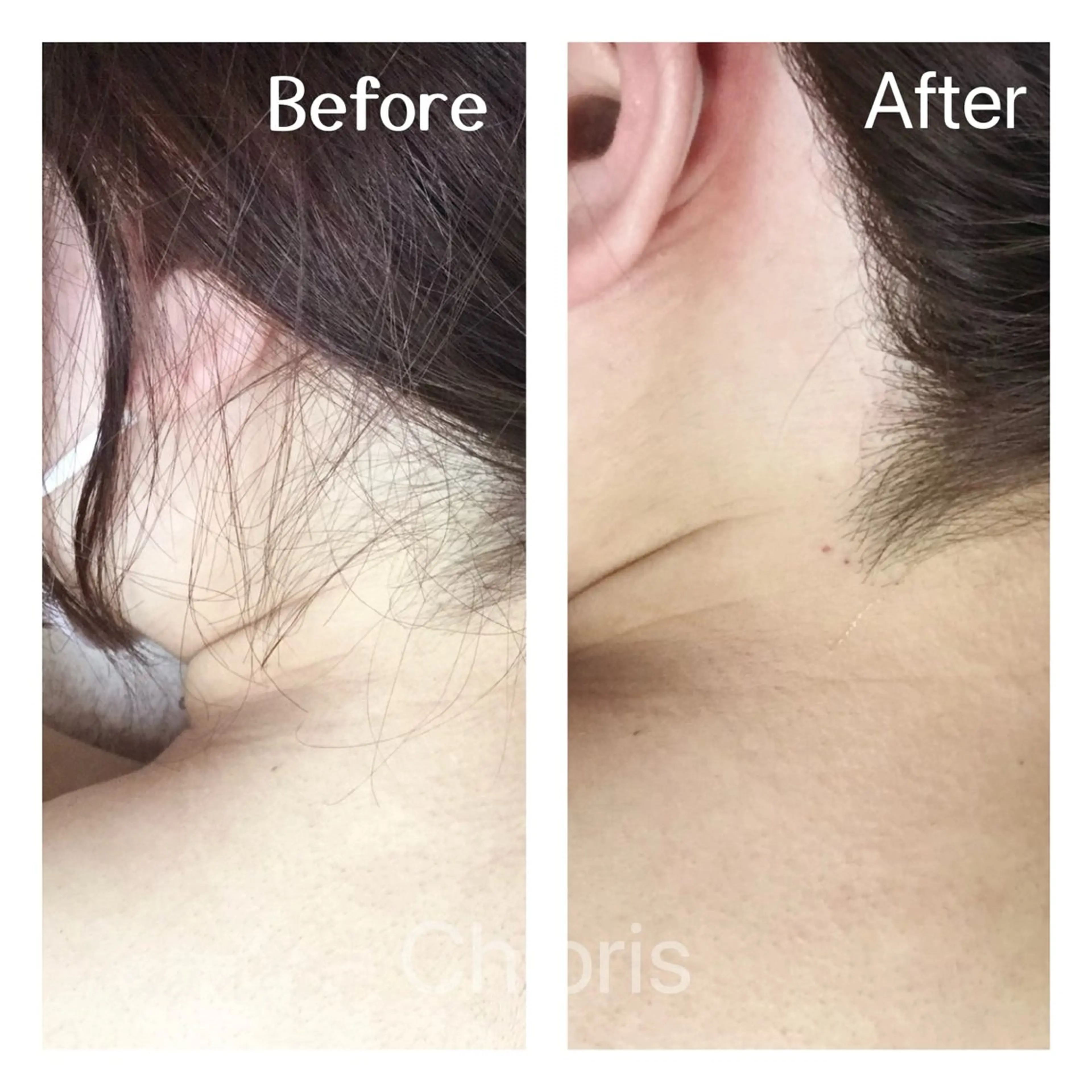 川越ローマピンク 光脱毛＆ワックス脱毛のエステ・リラクイメージ